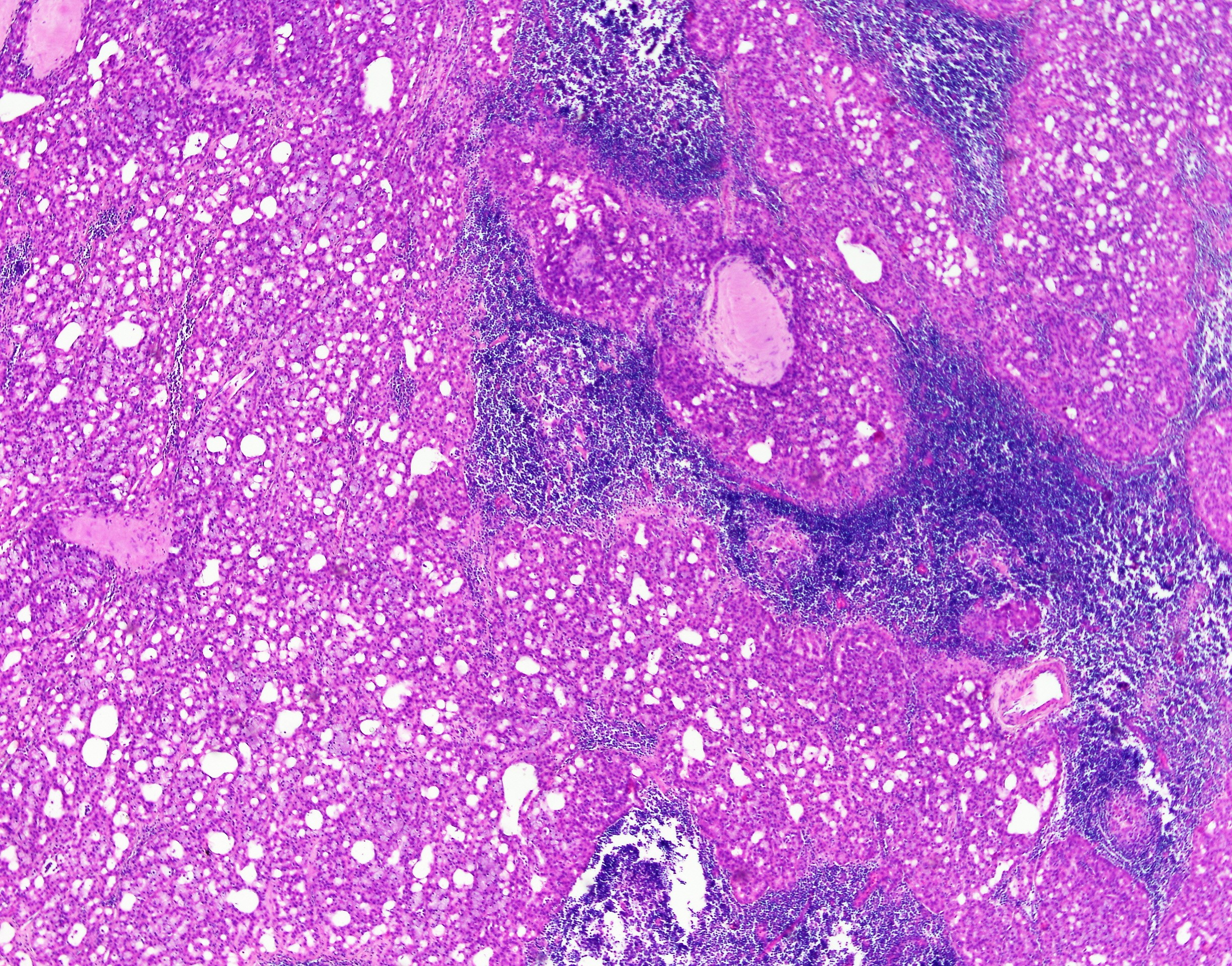 Acinar Cell Carcinoma Salivary1