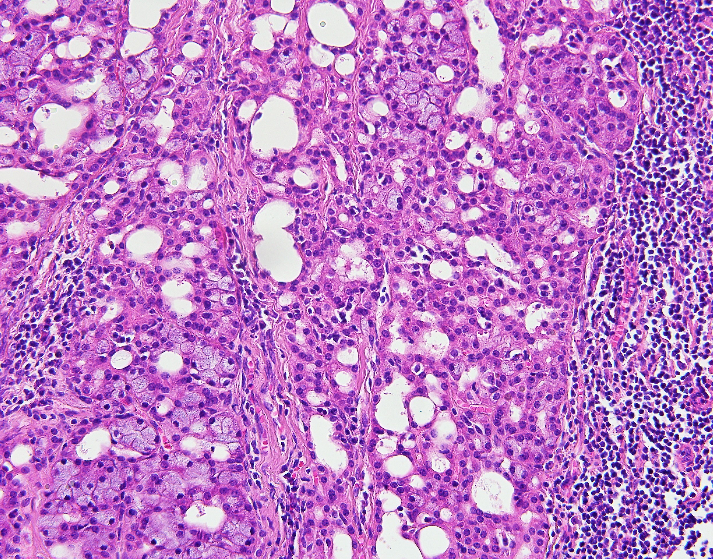 Acinar Cell Carcinoma Salivary2