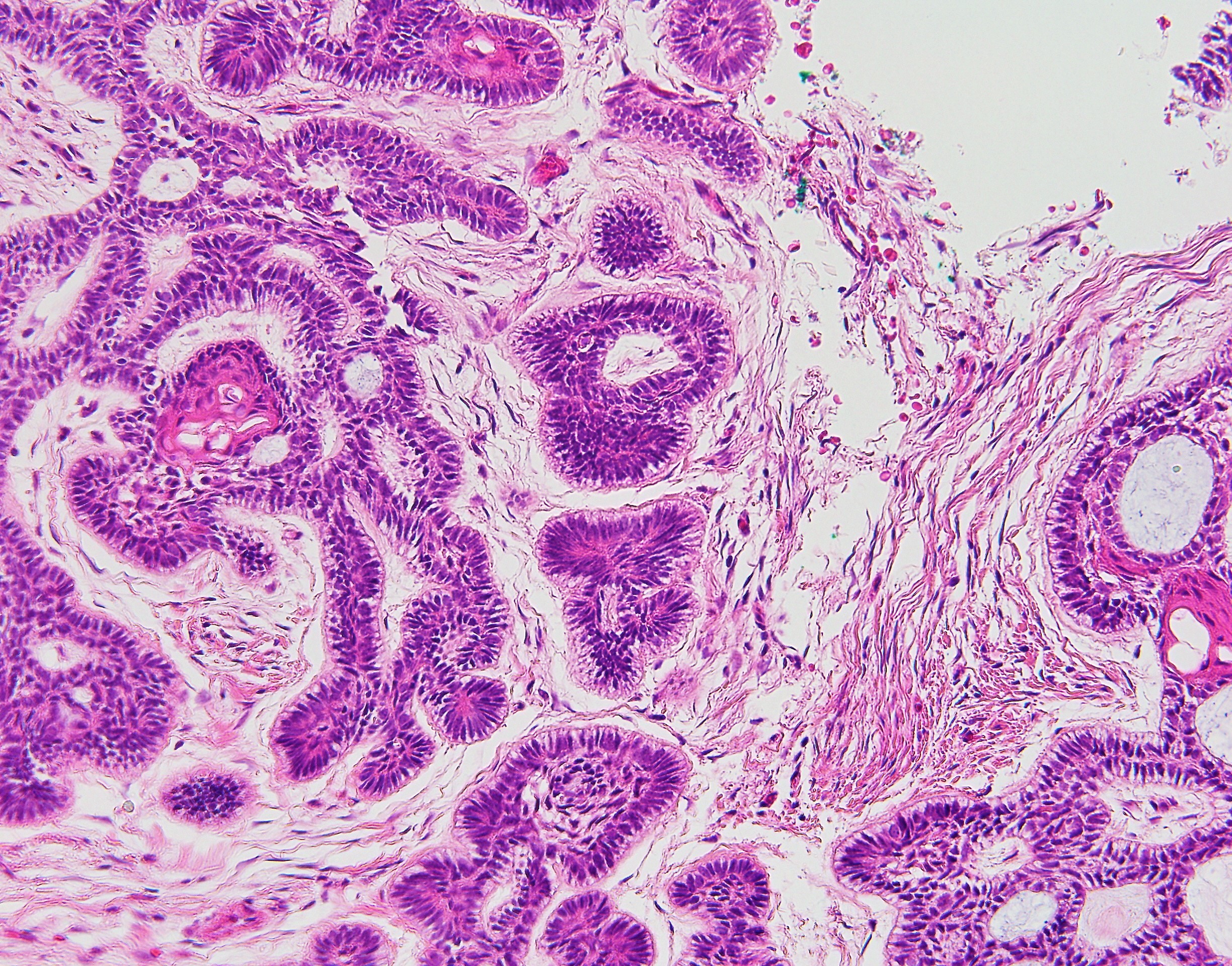 Ameloblastoma