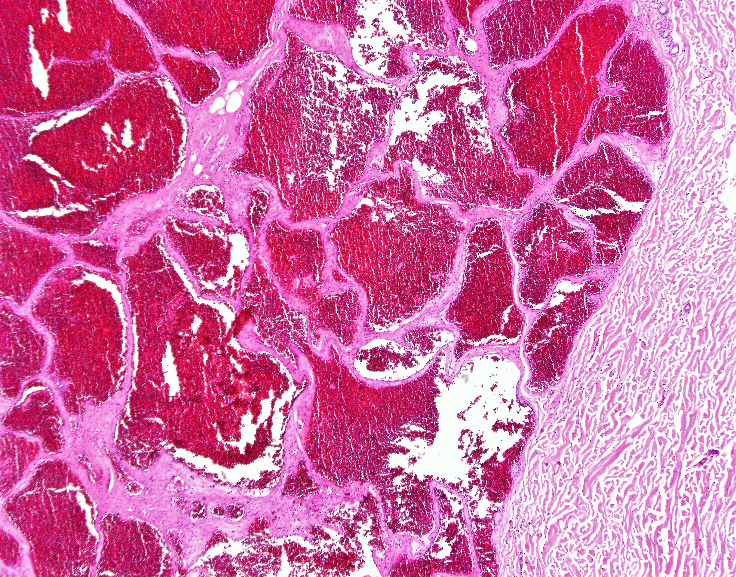 Cavernous Hemangioma1