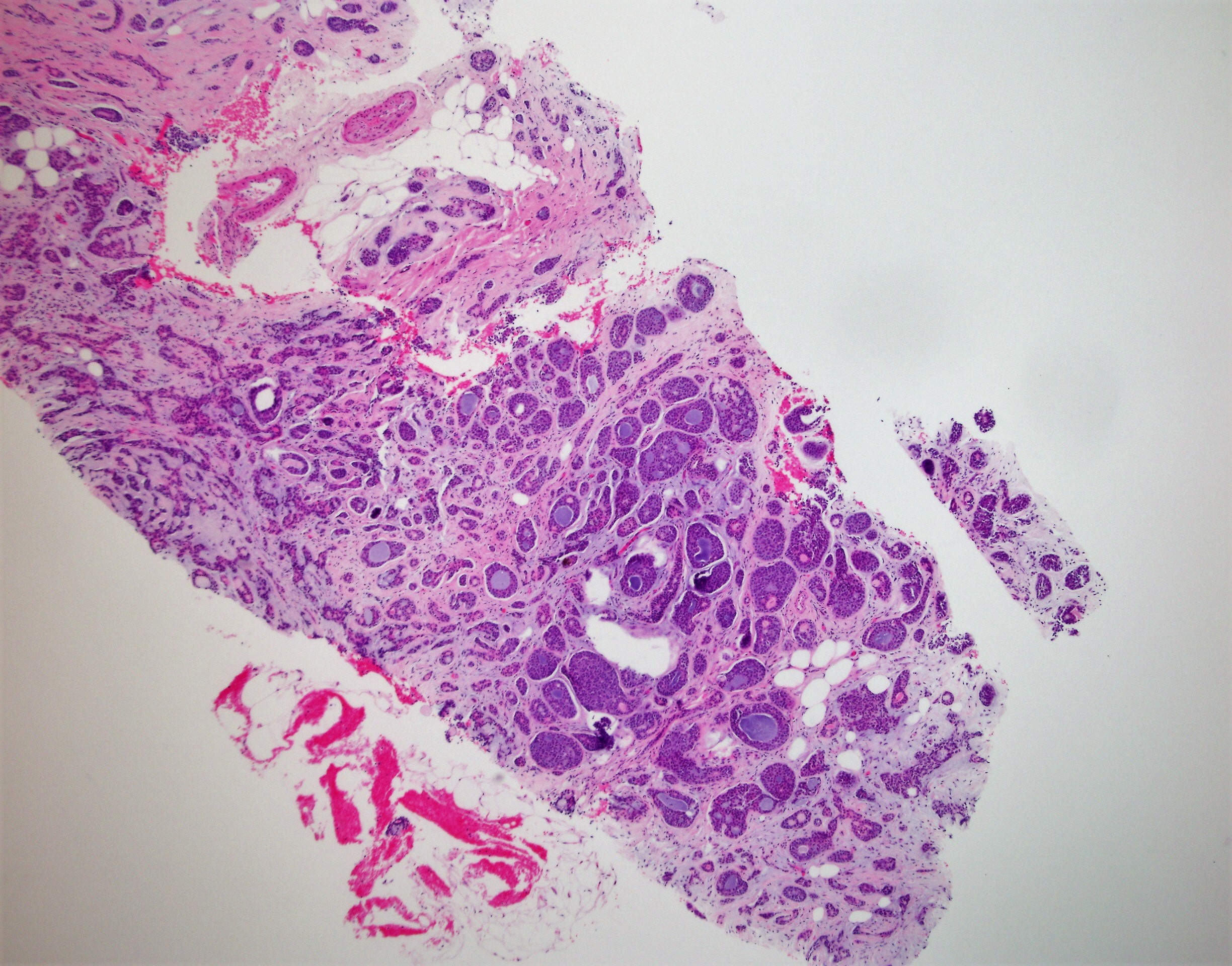 Adenoid Cystic Breast1