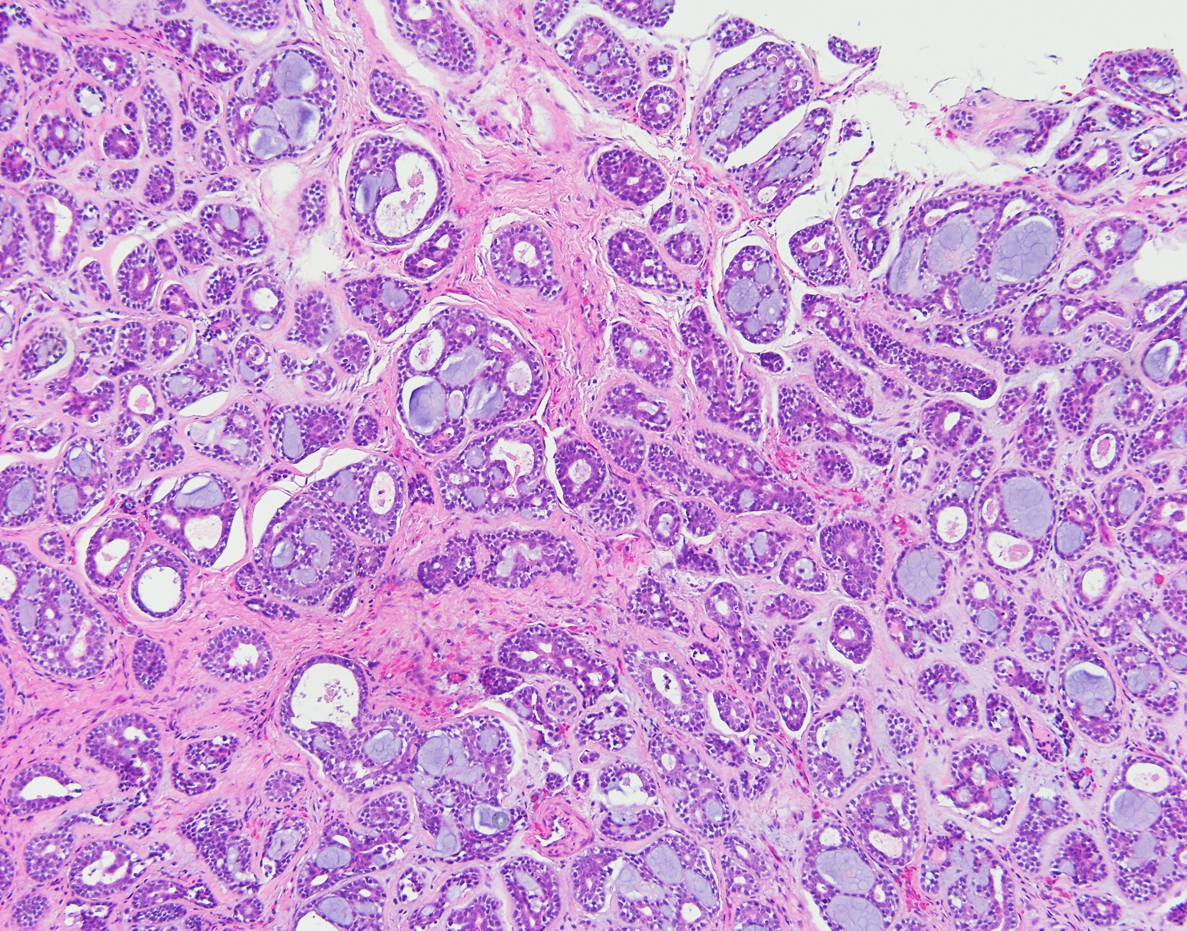 Adenoid Cystic Carcinoma Salivary Gland1