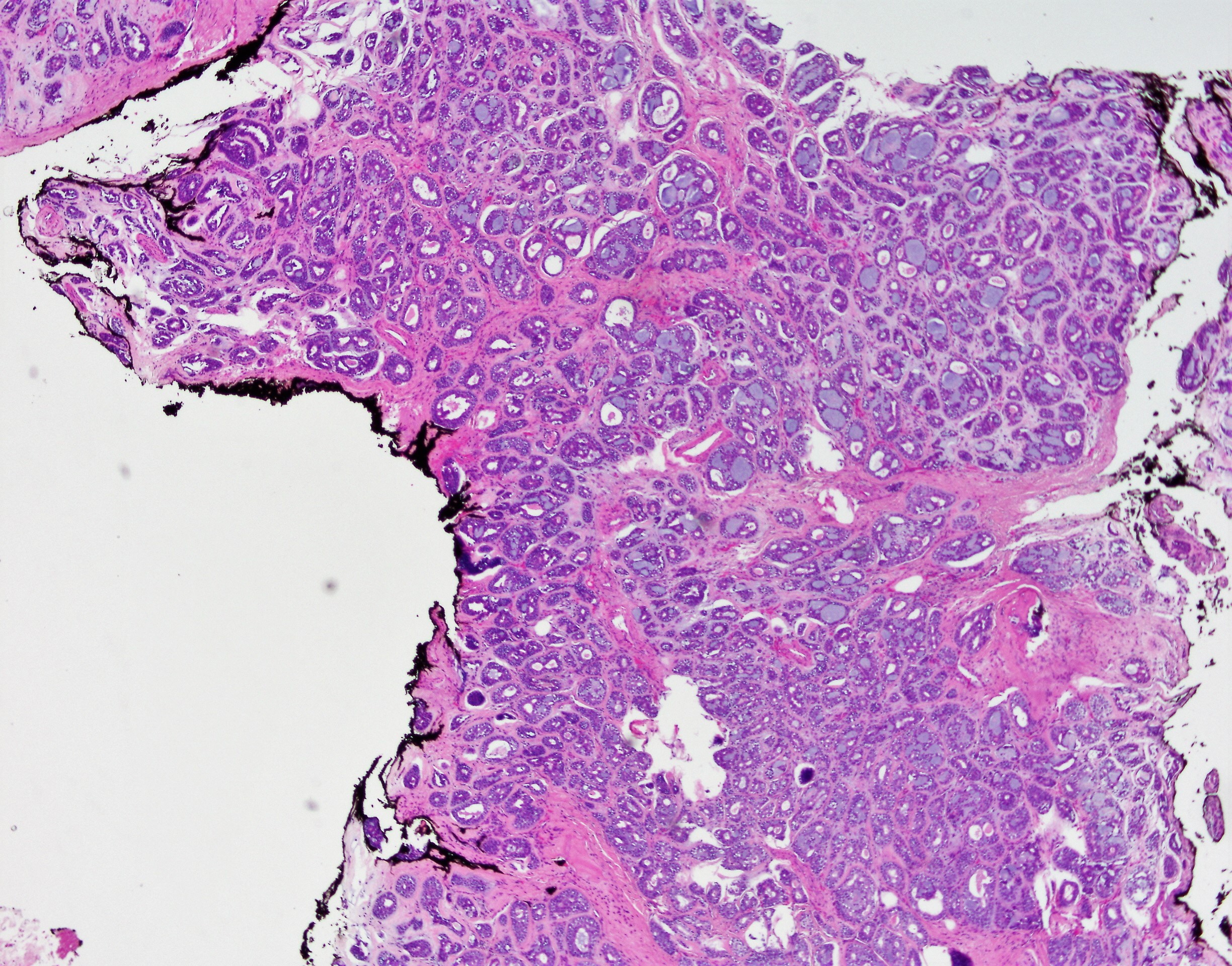 Adenoid Cystic Carcinoma Salivary Gland2