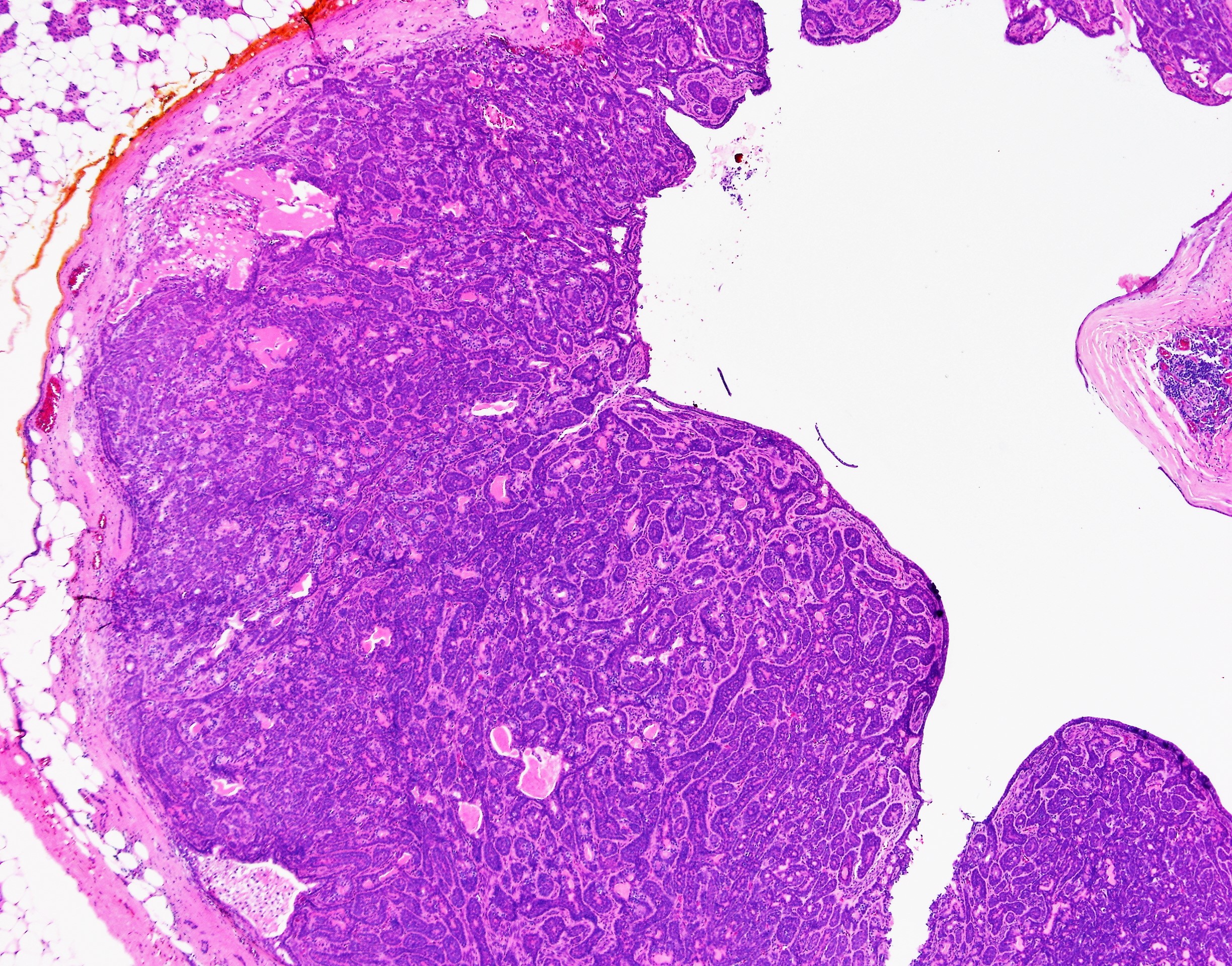 Basal Cell Adenoma1