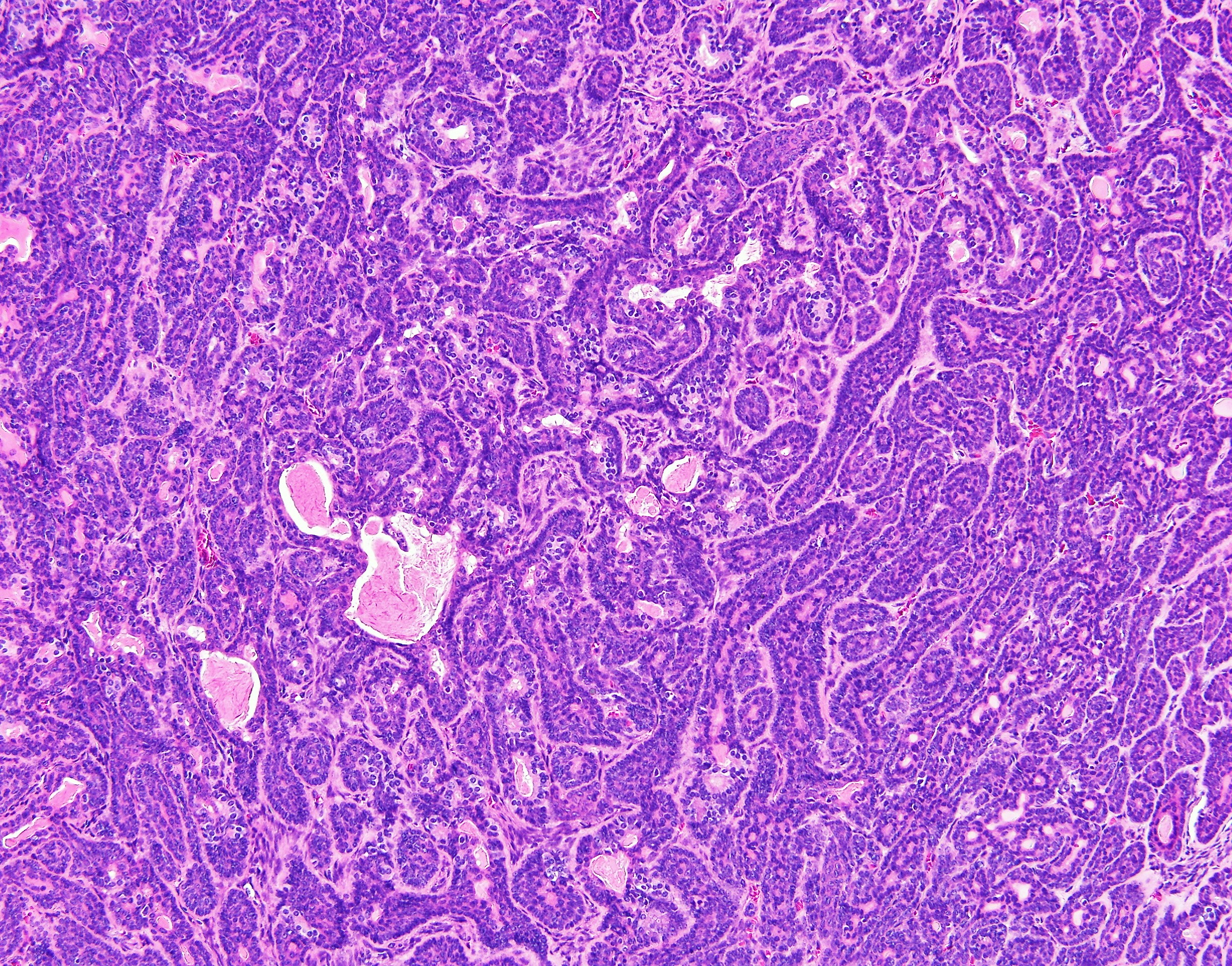 Basal Cell Adenoma2