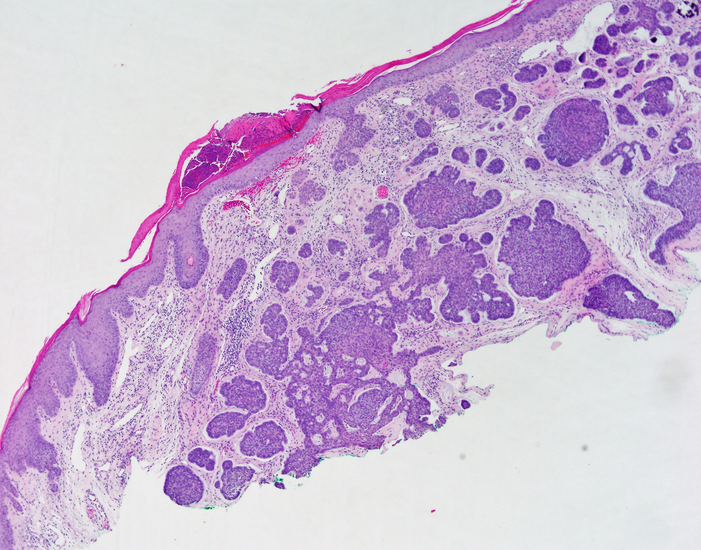 Basal Cell Carcinoma 1