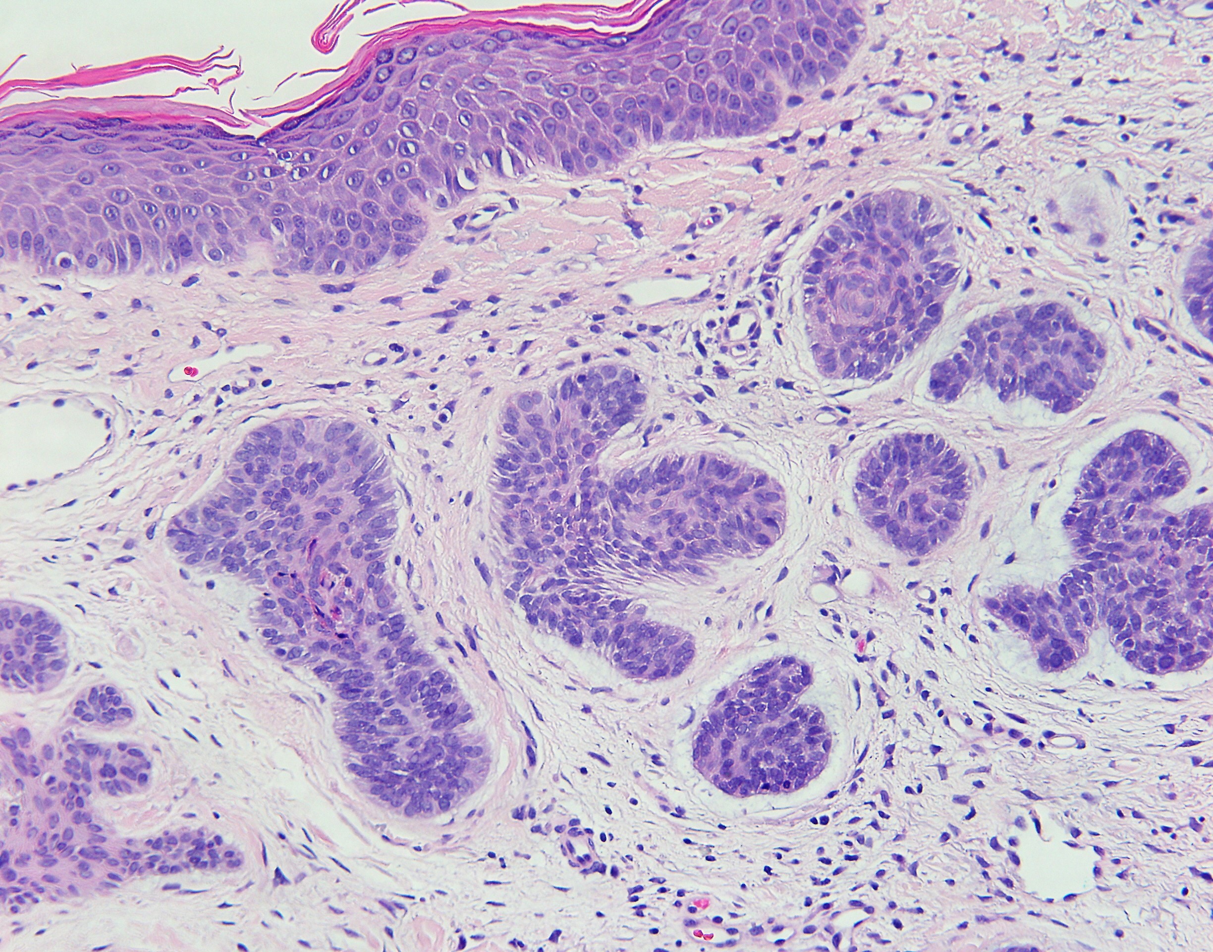 Basal Cell Carcinoma 2