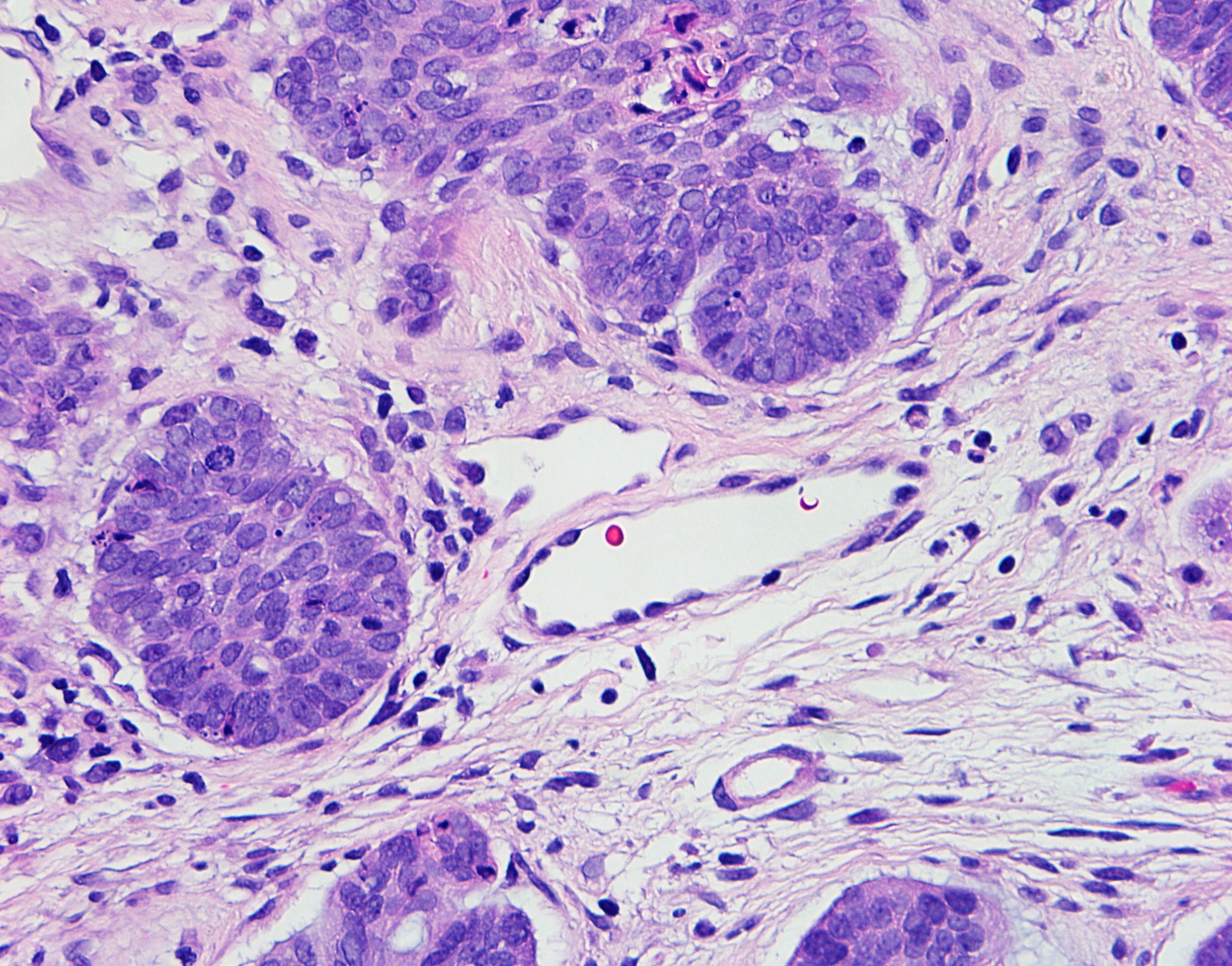 Basal Cell Carcinoma 3