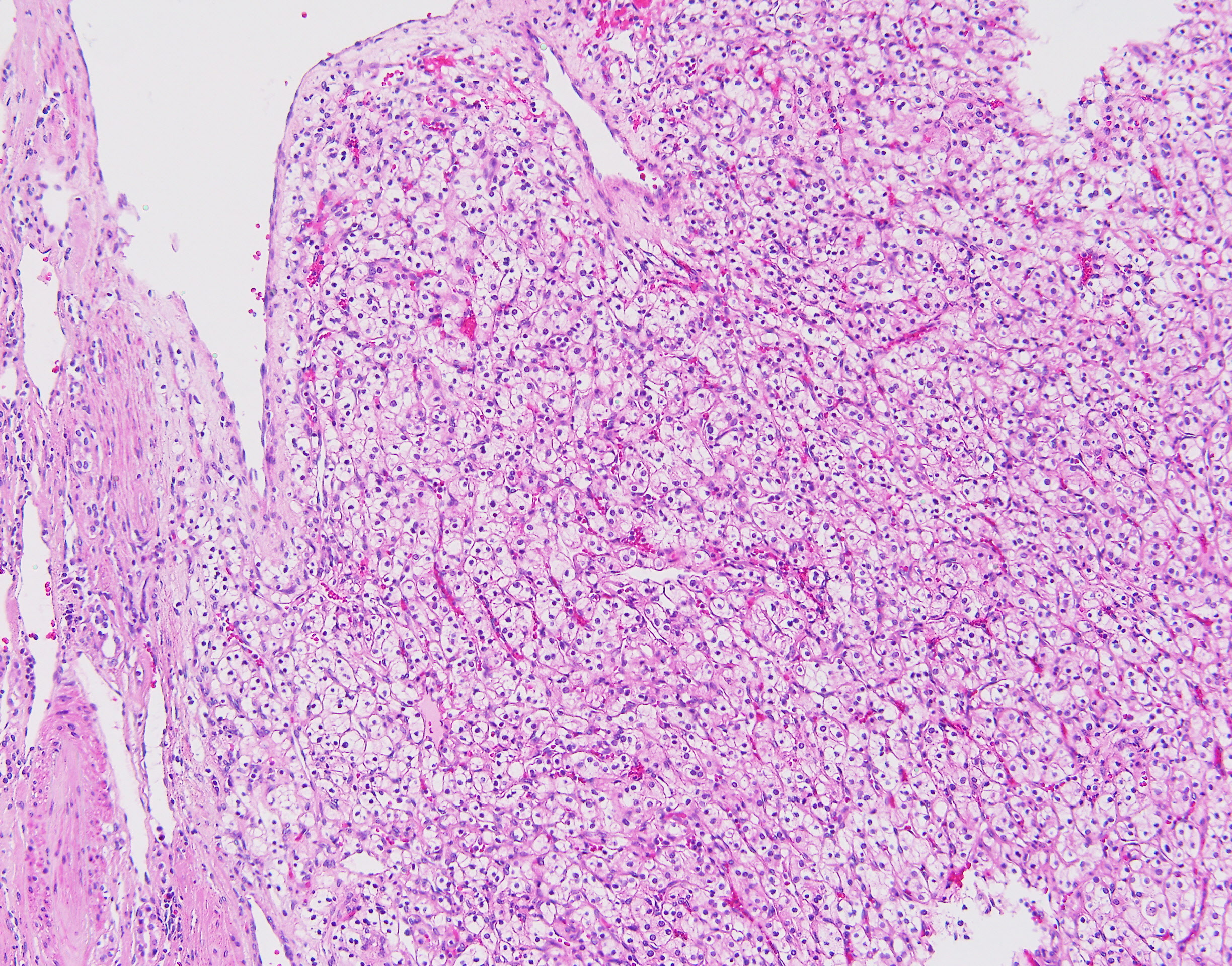 Clear Cell Renal Cell Carcinoma #1