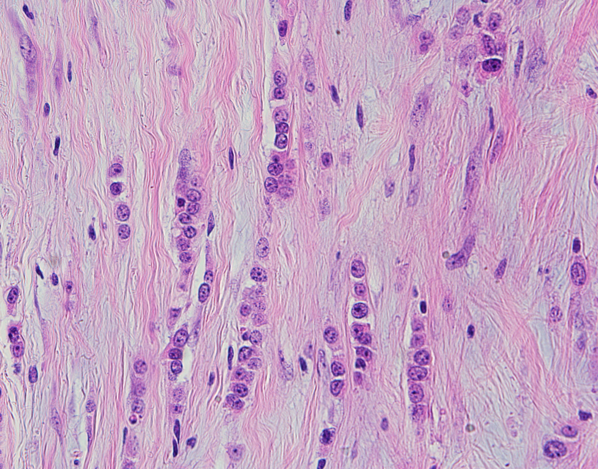 Lobular Breast Carcinoma2