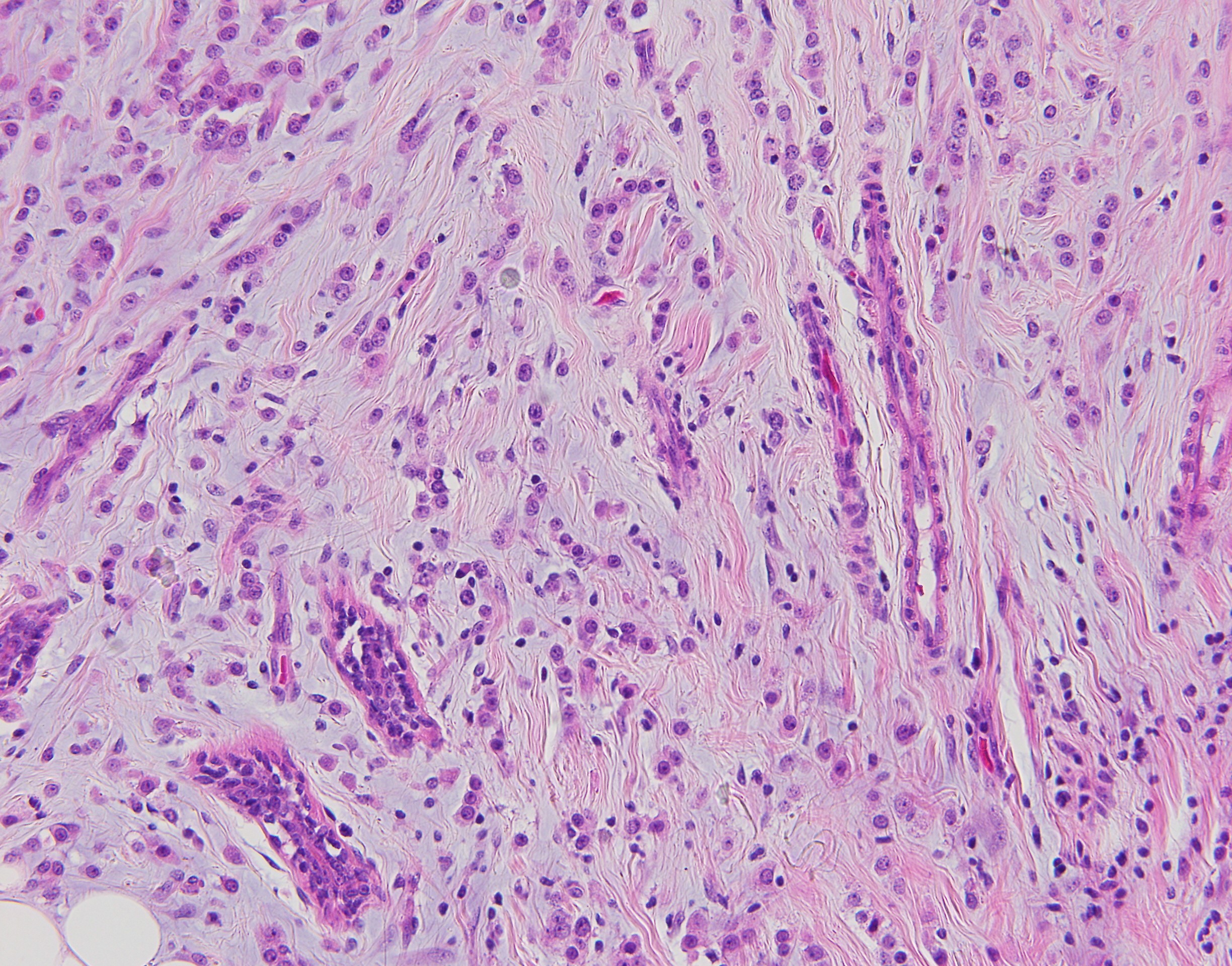 Lobular Breast Carcinoma3