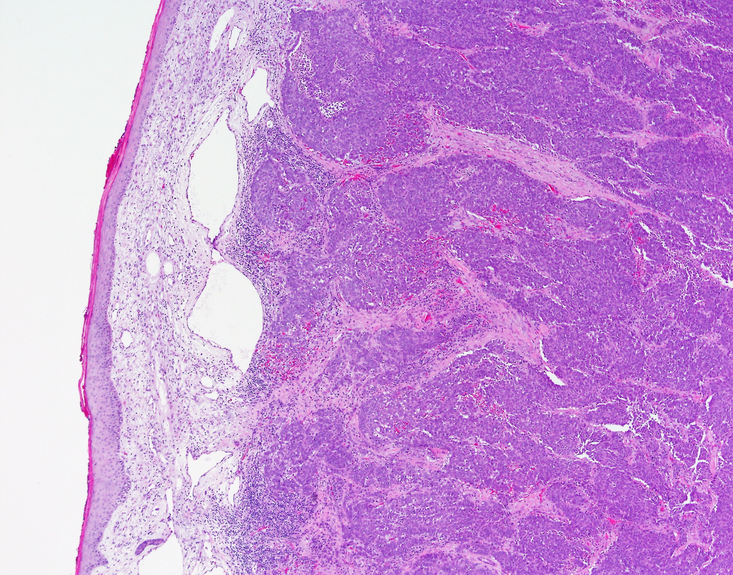 Merkel Cell Carcinoma1