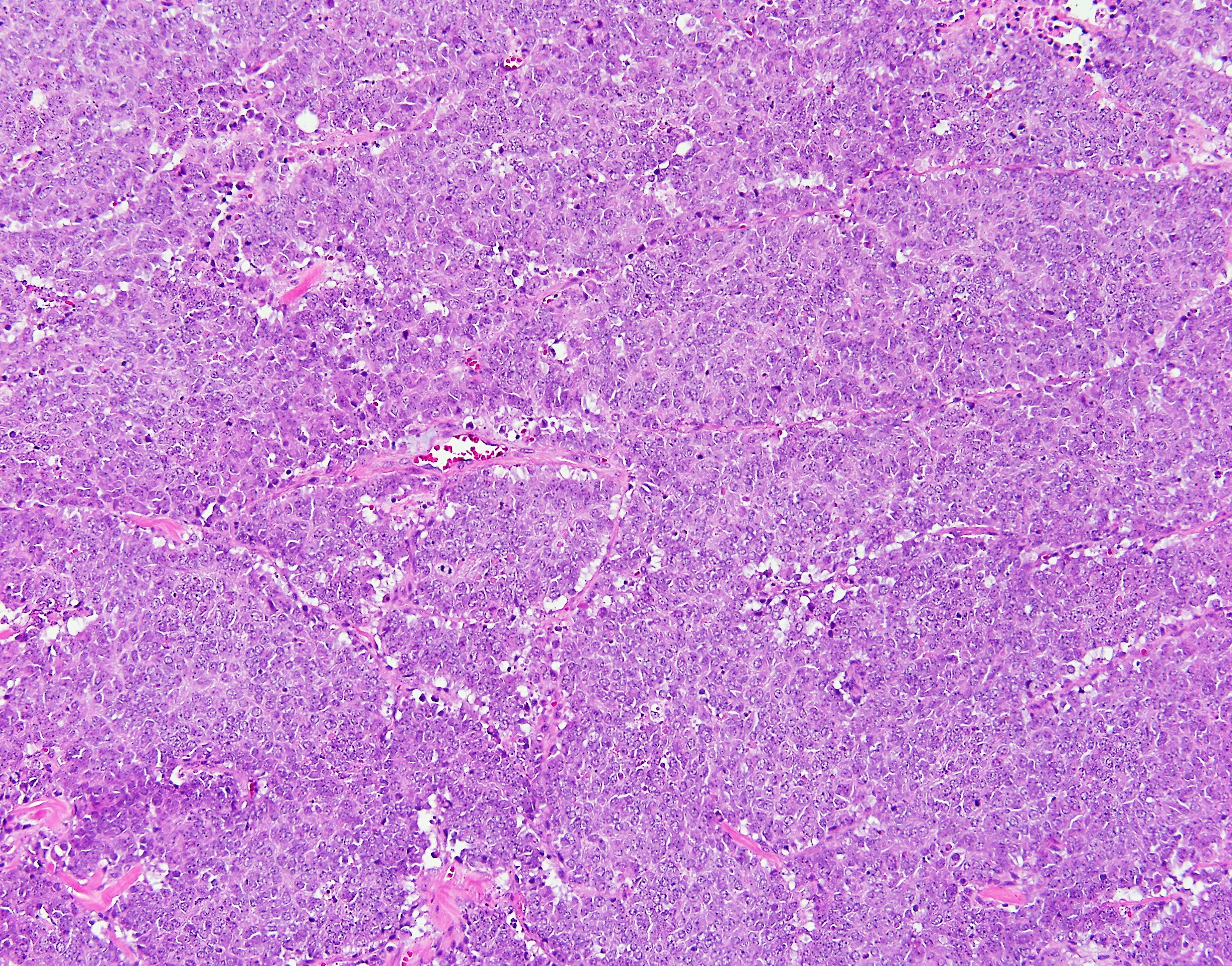 Merkel Cell Carcinoma2