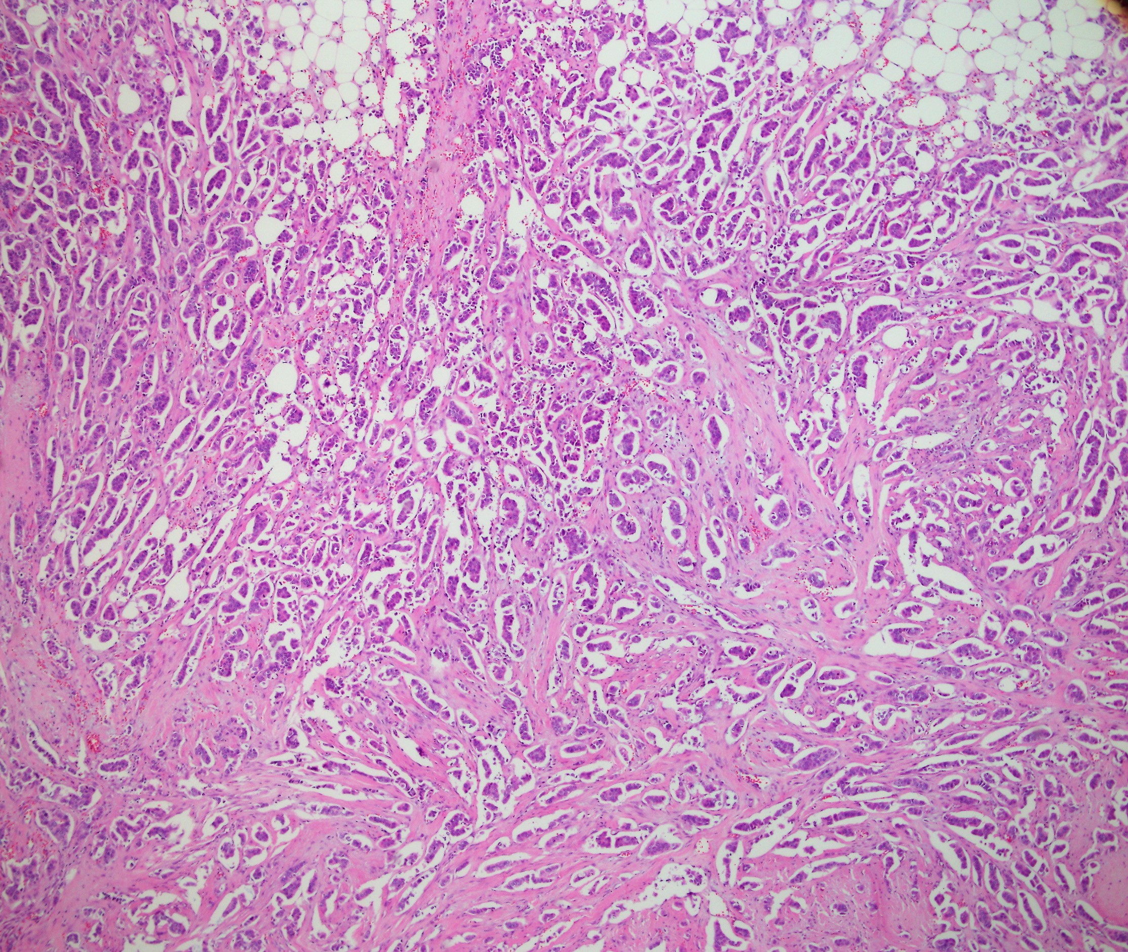 Micropapillay Breast Carcinoma1