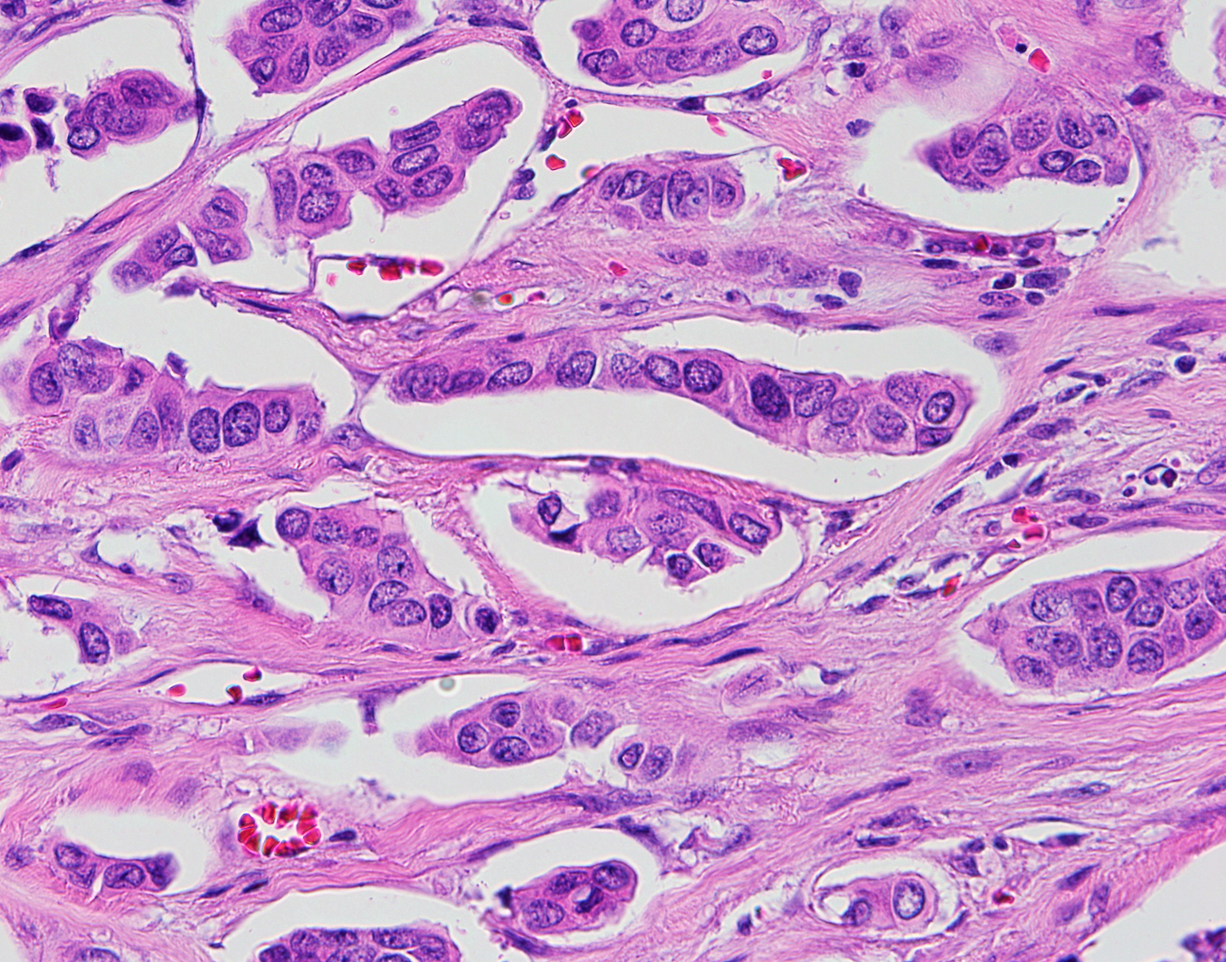 Micropapillay Breast Carcinoma2