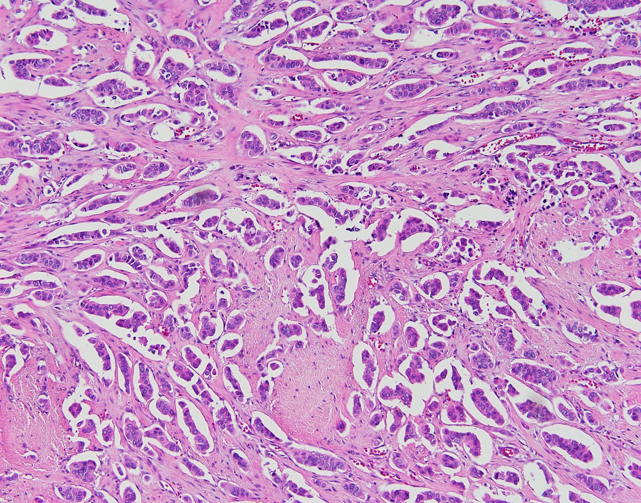 Micropapillay Breast Carcinoma3