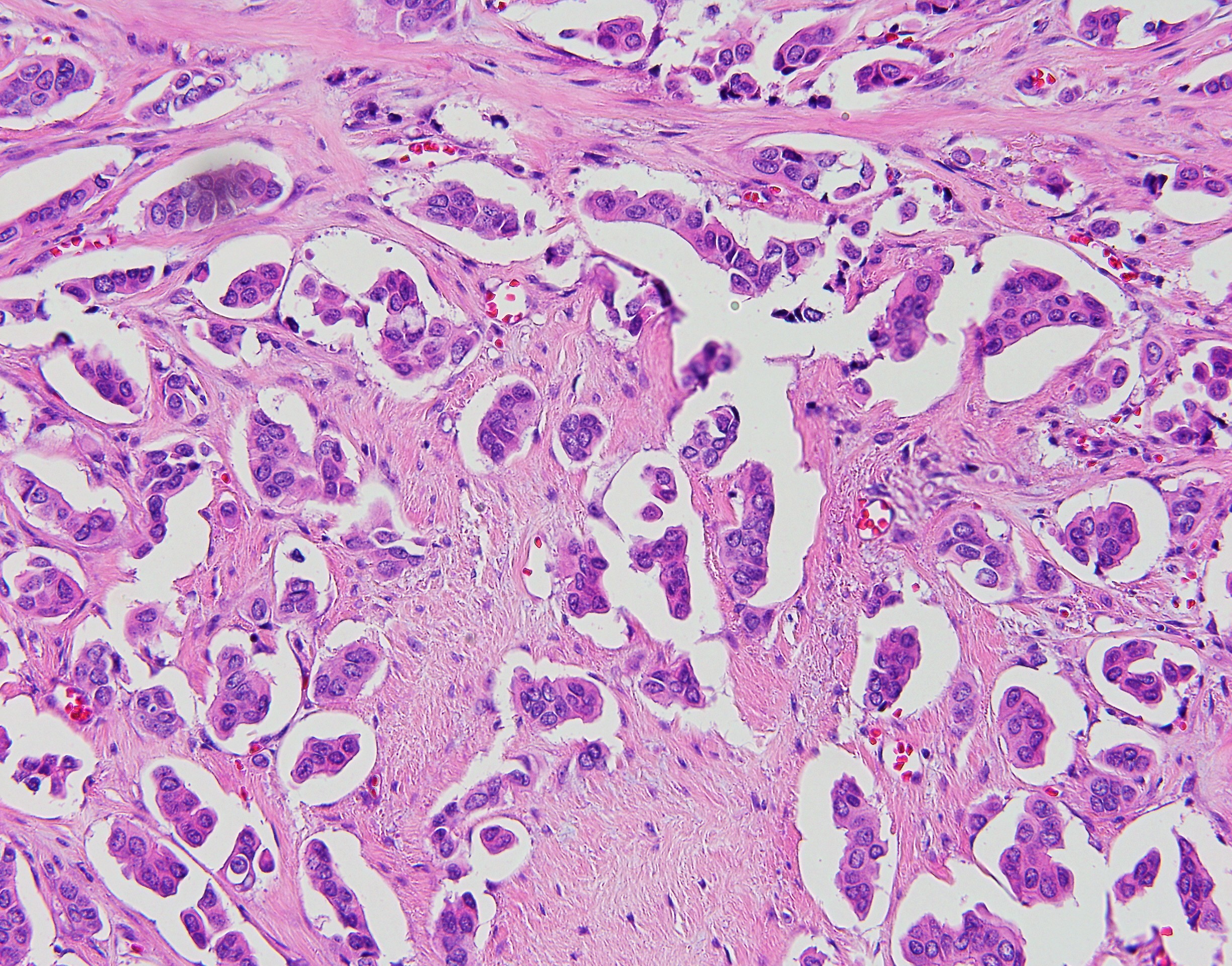 Micropapillay Breast Carcinoma4