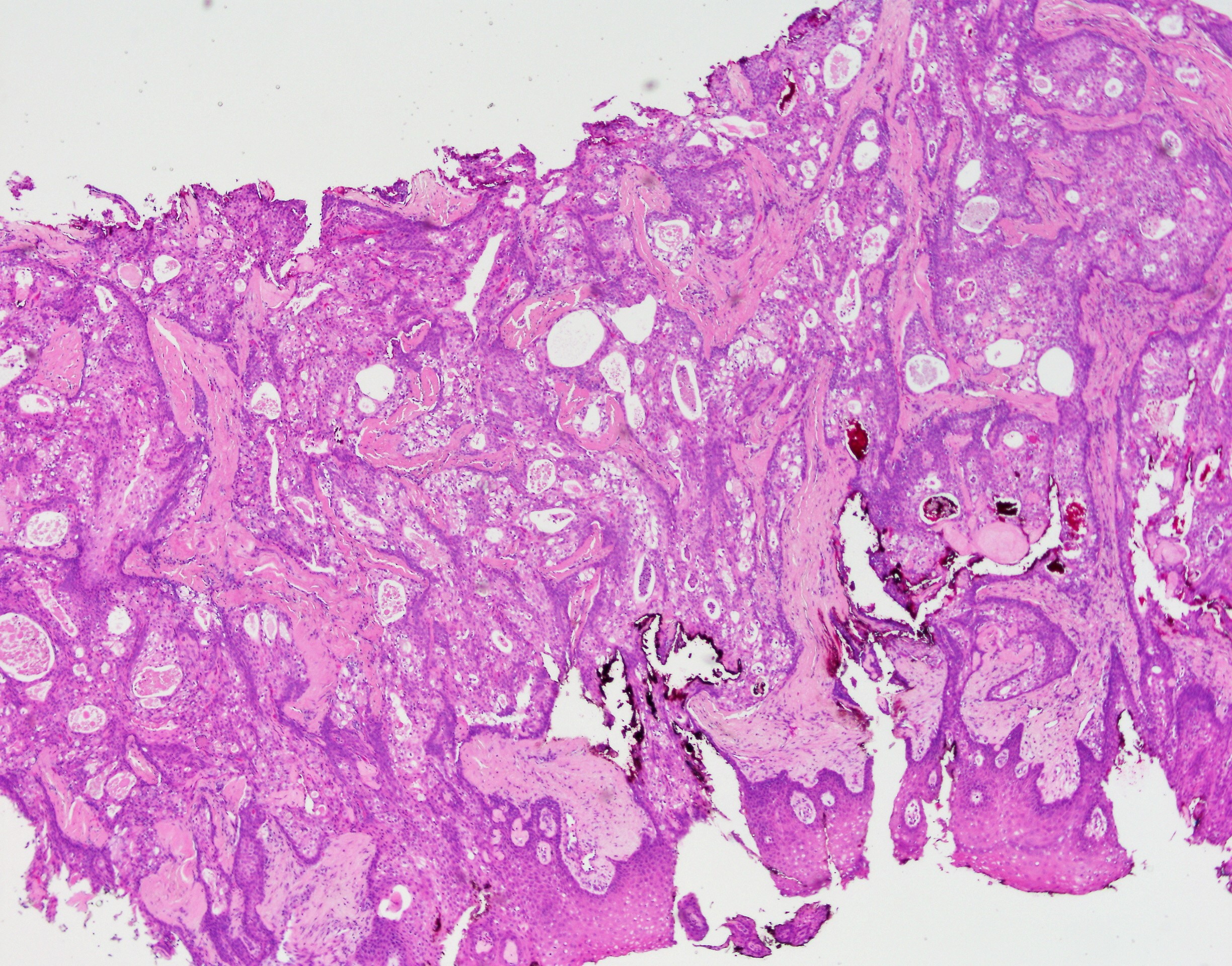 Mucoepidermoid Carcinoma1