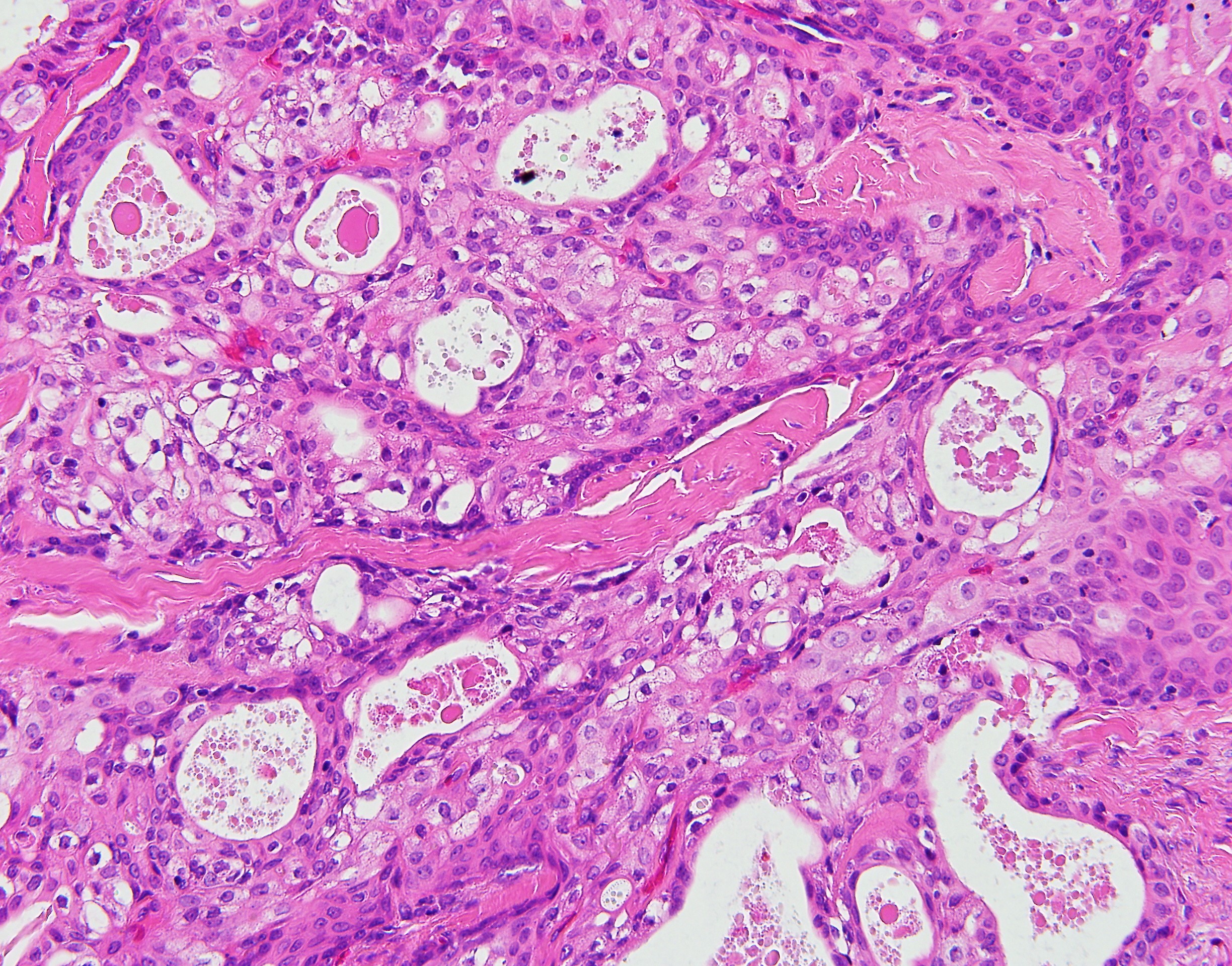 Mucoepidermoid Carcinoma2