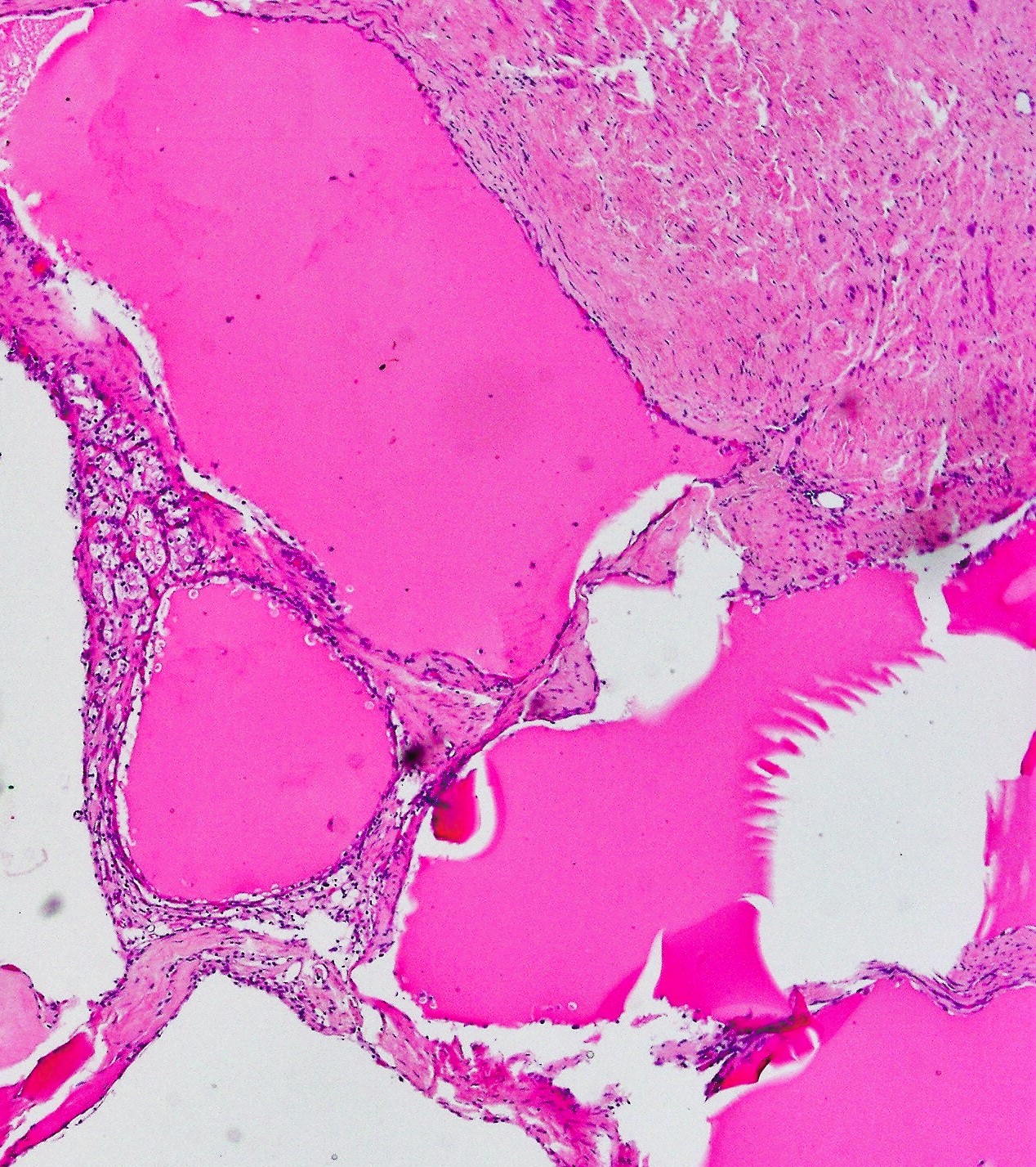 Multilocular cystic neoplams of low malignant potential1