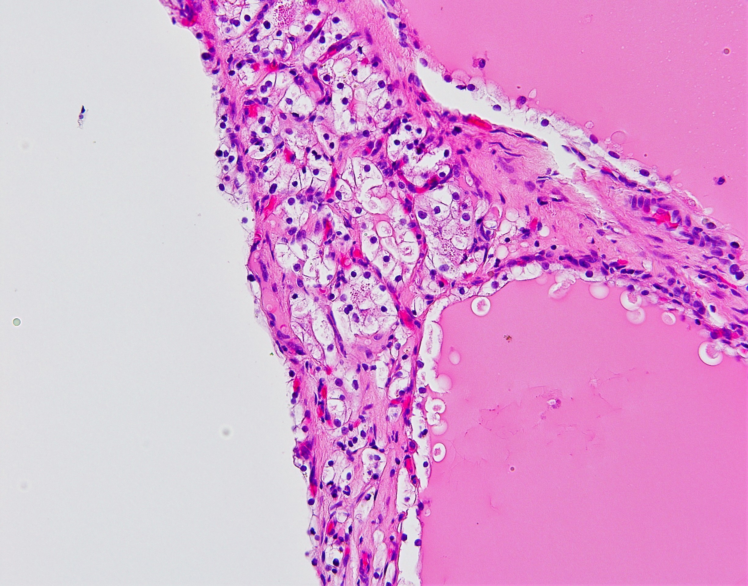 Multilocular cystic neoplams of low malignant potential2