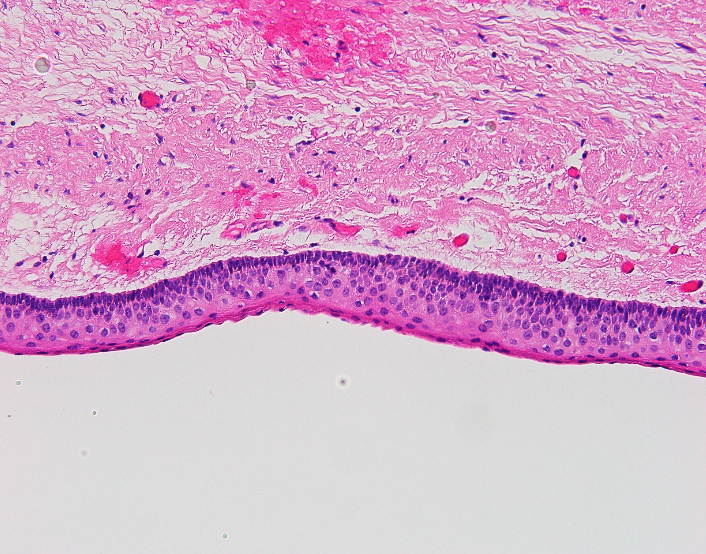 Odontogenic keratocyst