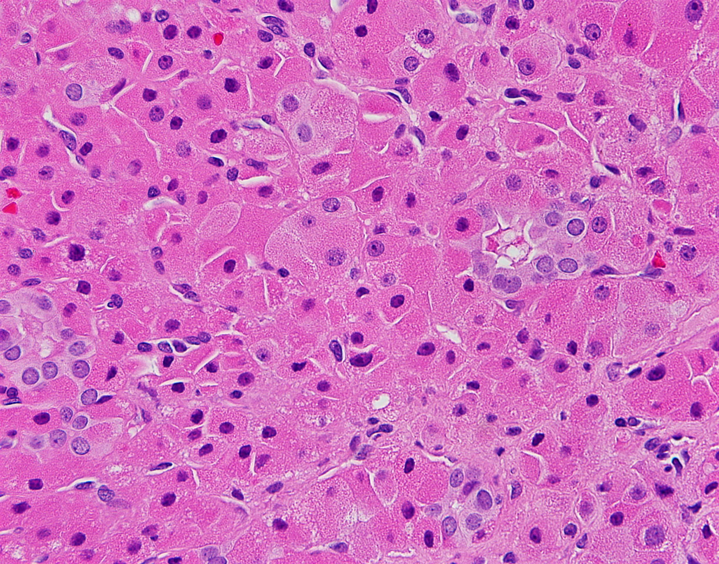 Oncocytoma