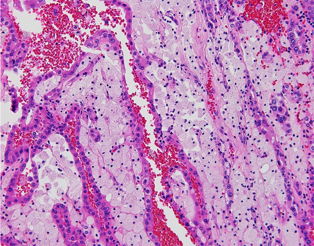 Papillary Renal Cell Carcinoma 3