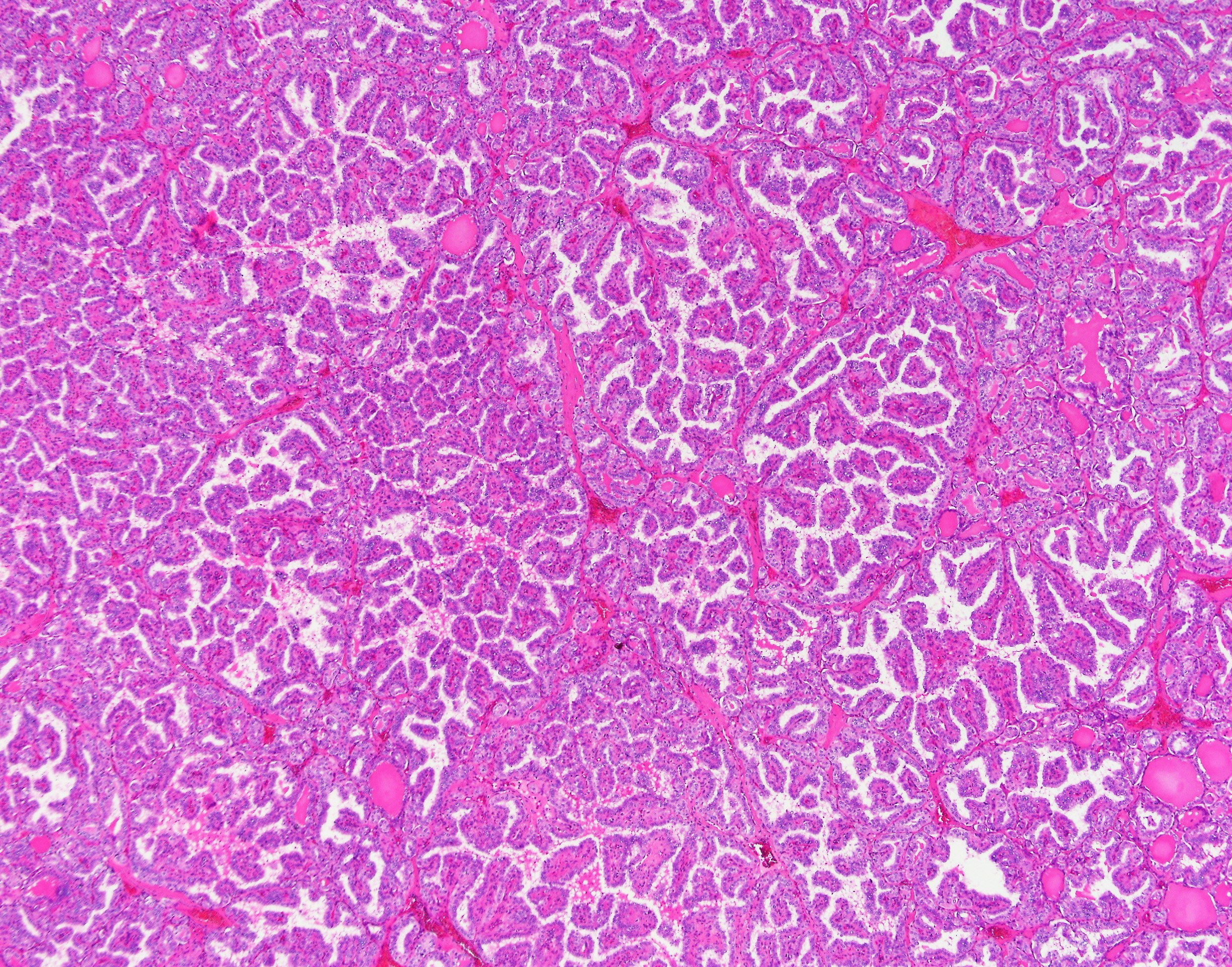 Papillary Thyroid Carcinoma1