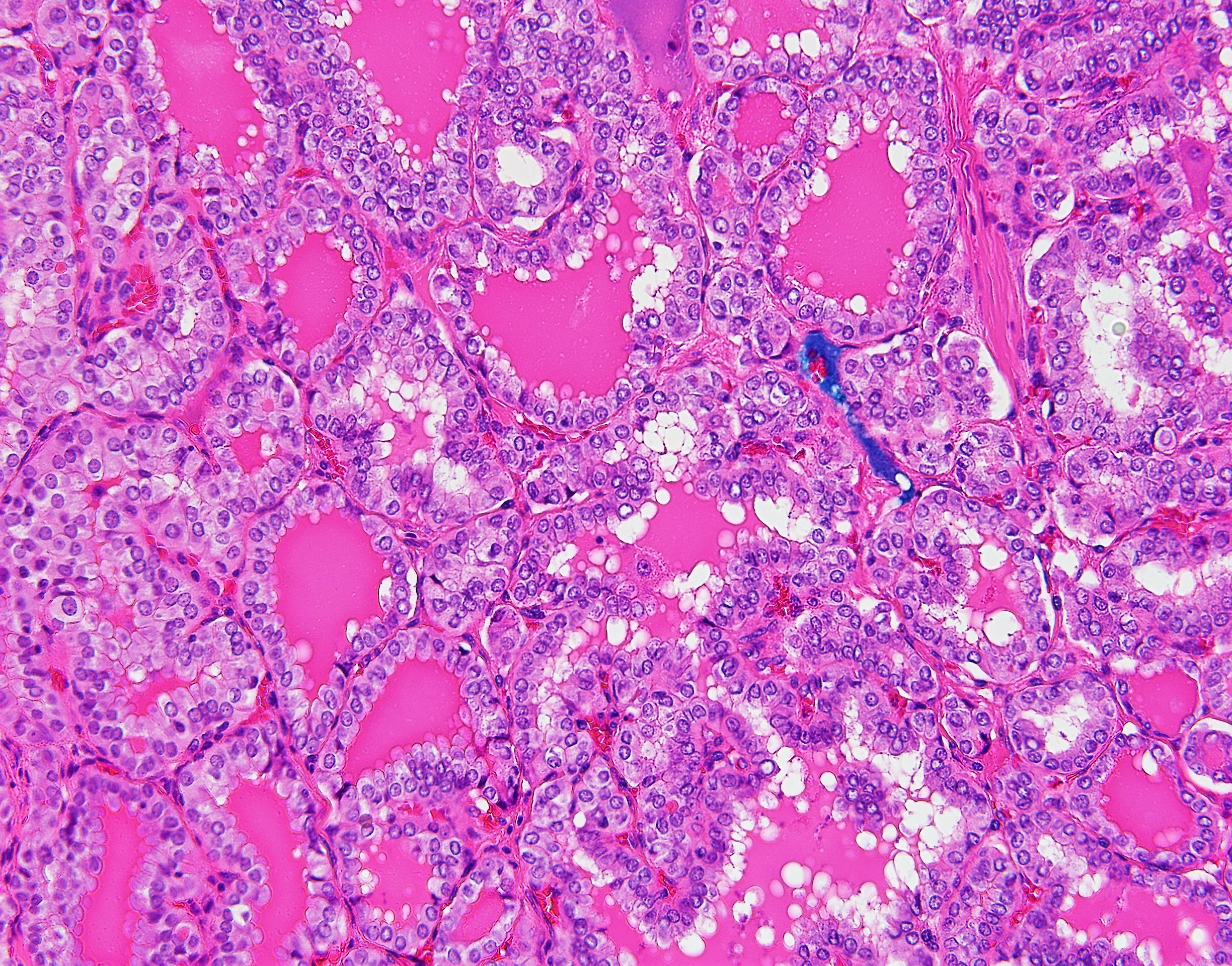Papillary Thyroid Carcinoma2
