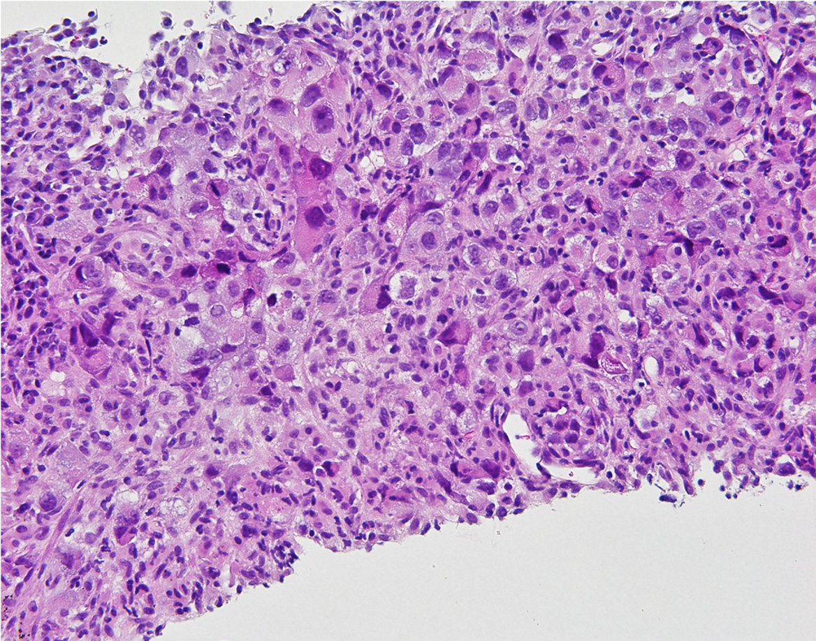 Poorly differentiated lung adenocarcinoma