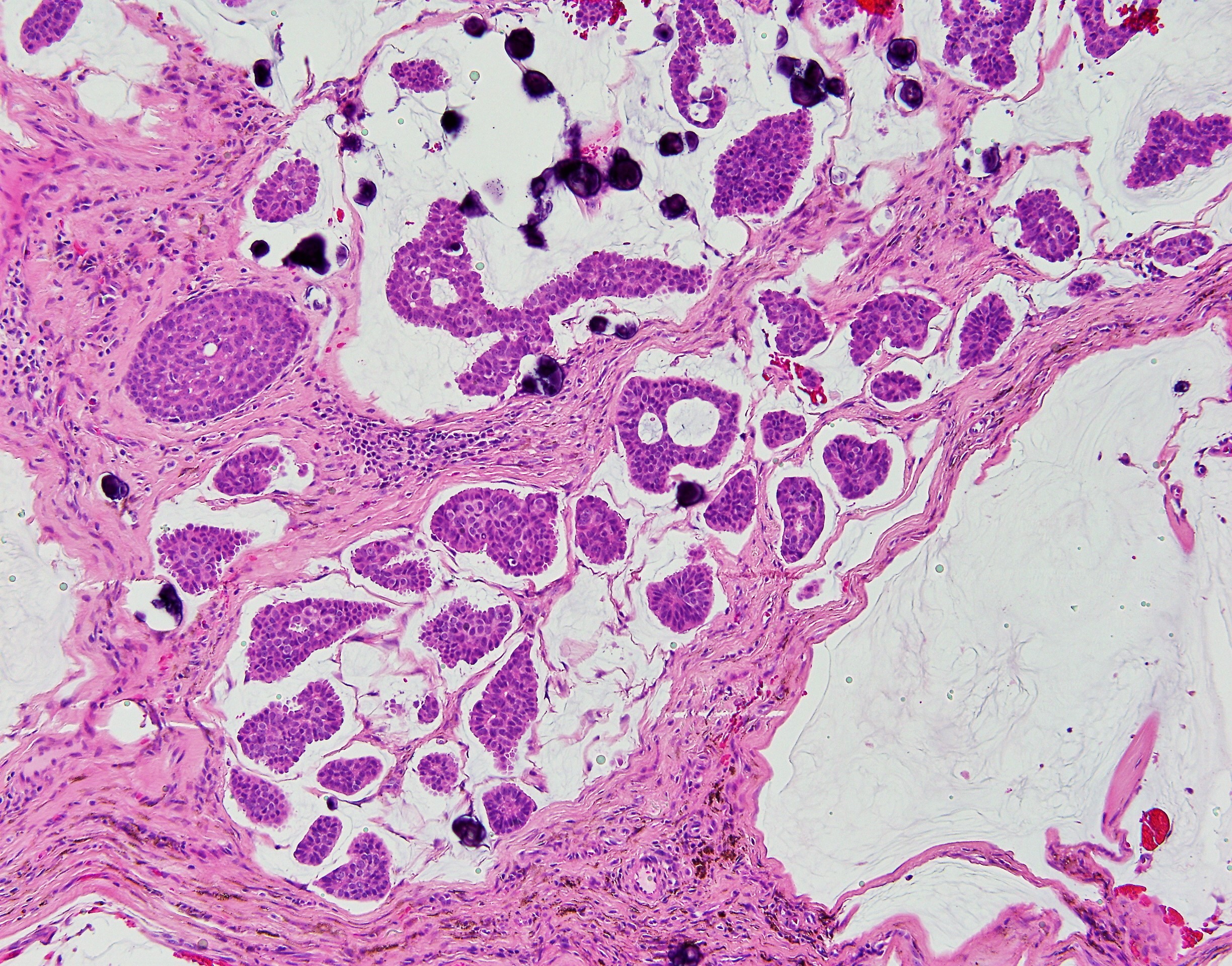 Primary Cutaneous Mucinous Carcinoma 2