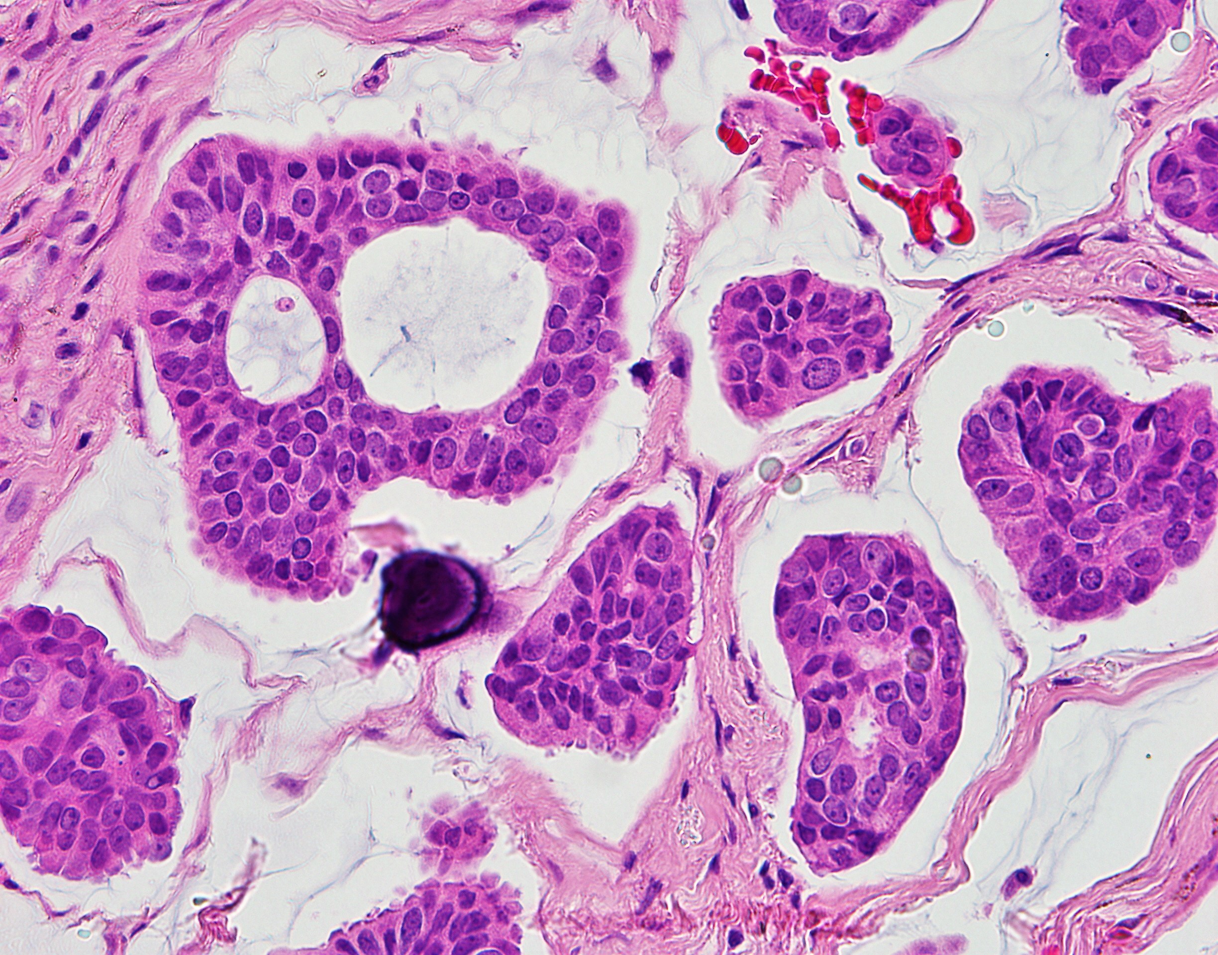 Primary Cutaneous Mucinous Carcinoma 3