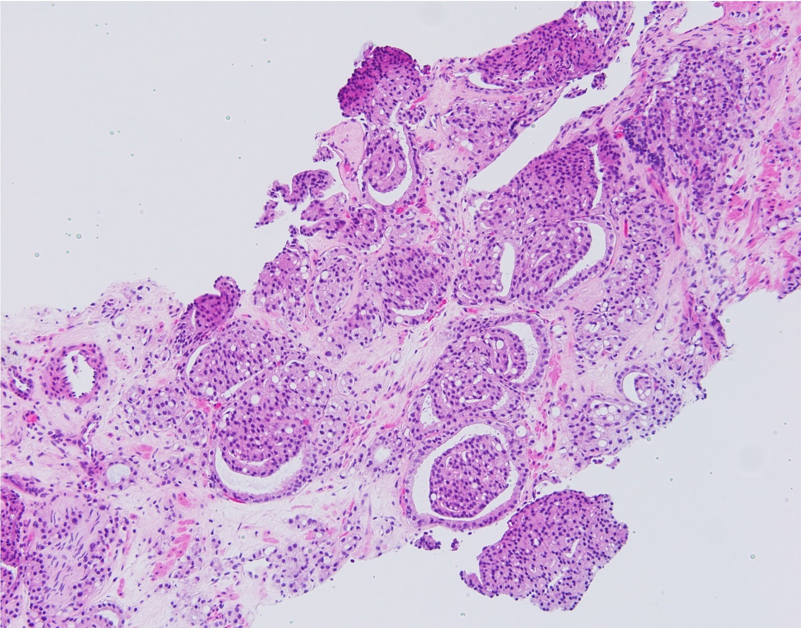 Prostatic Adenocarcinoma 3