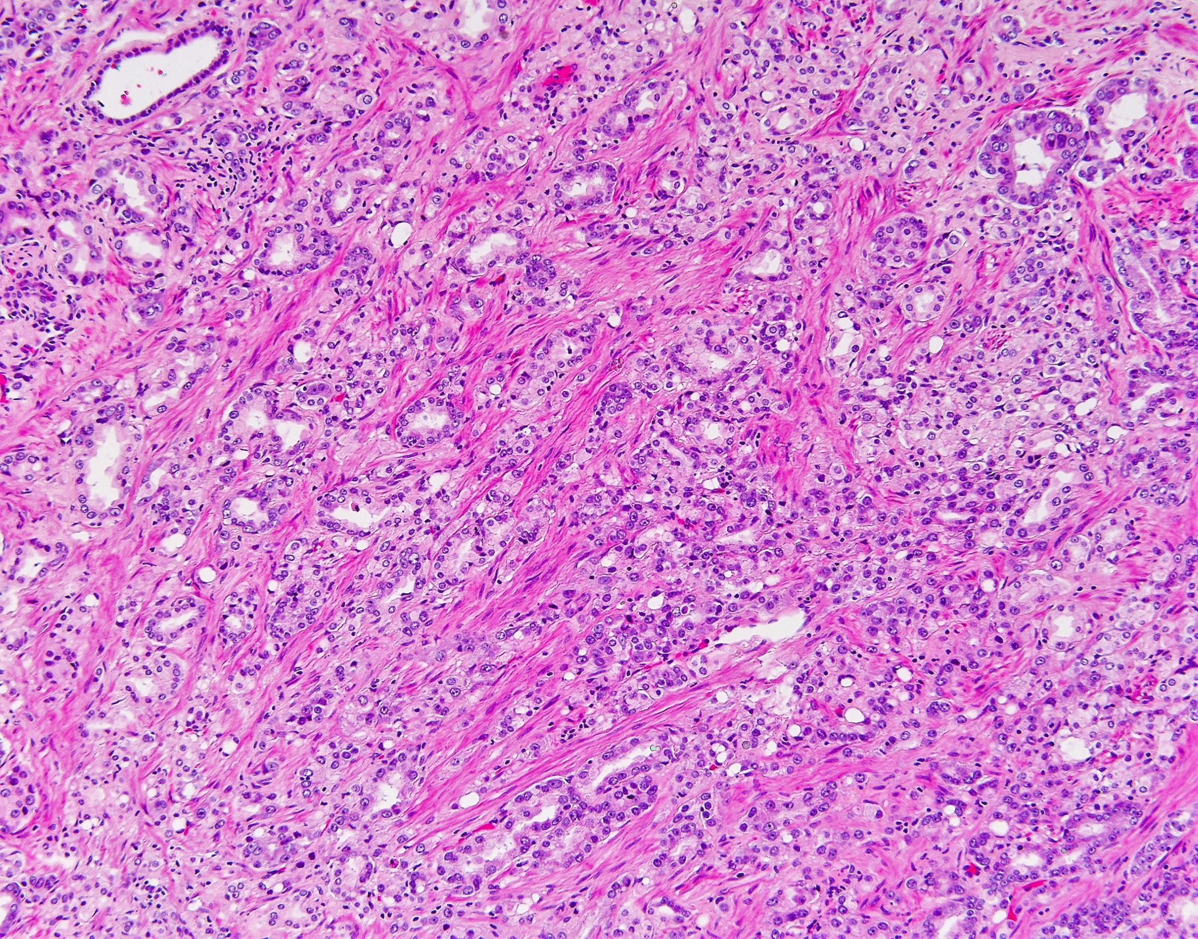 Prostatic adenocarcinoma