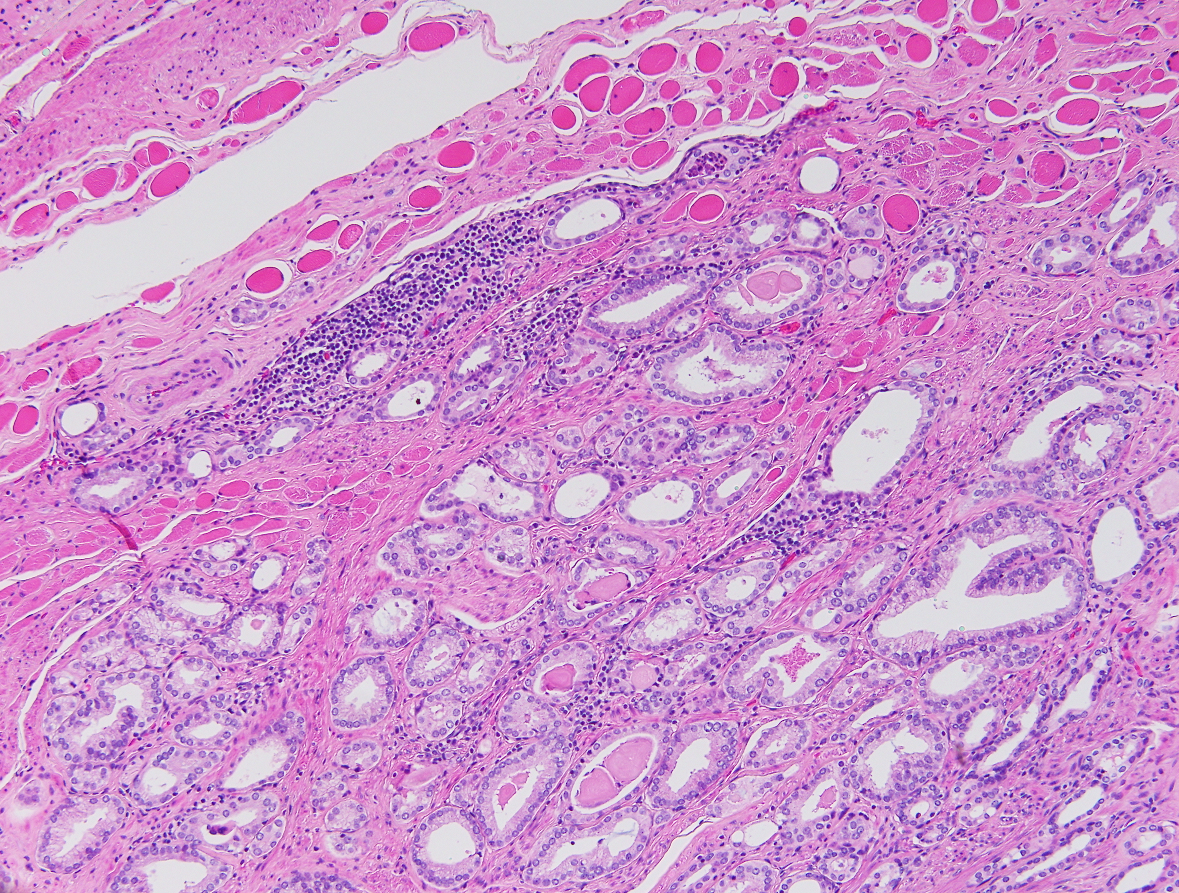 Prostatic adenocarcinoma