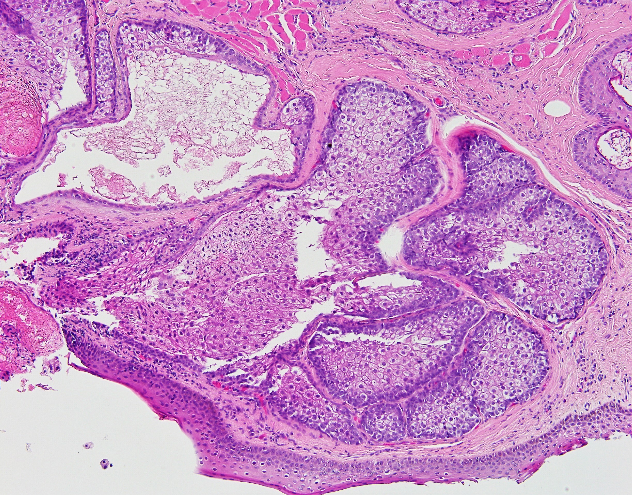 Sebecaous Adenoma2