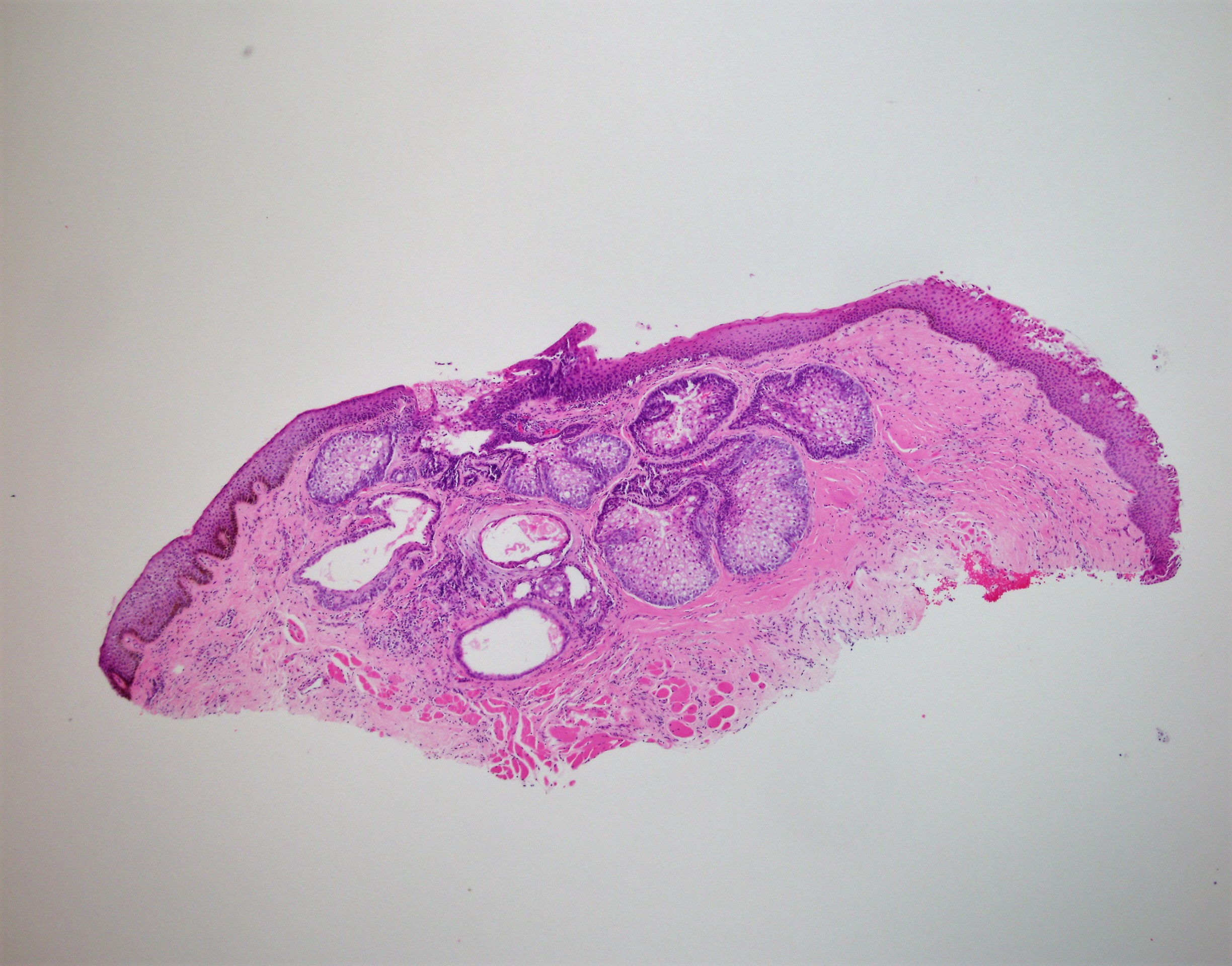 Sebecaous Adenoma1