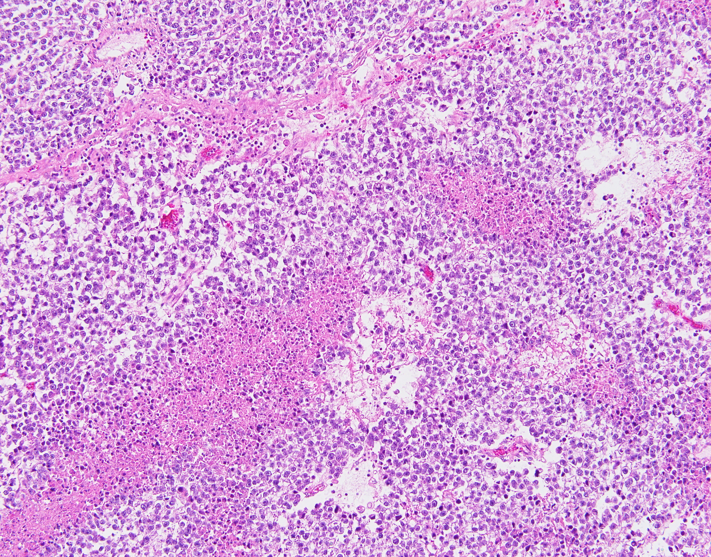 Seminoma1