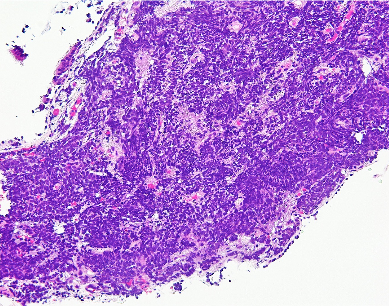 Small Cell Carcinoma