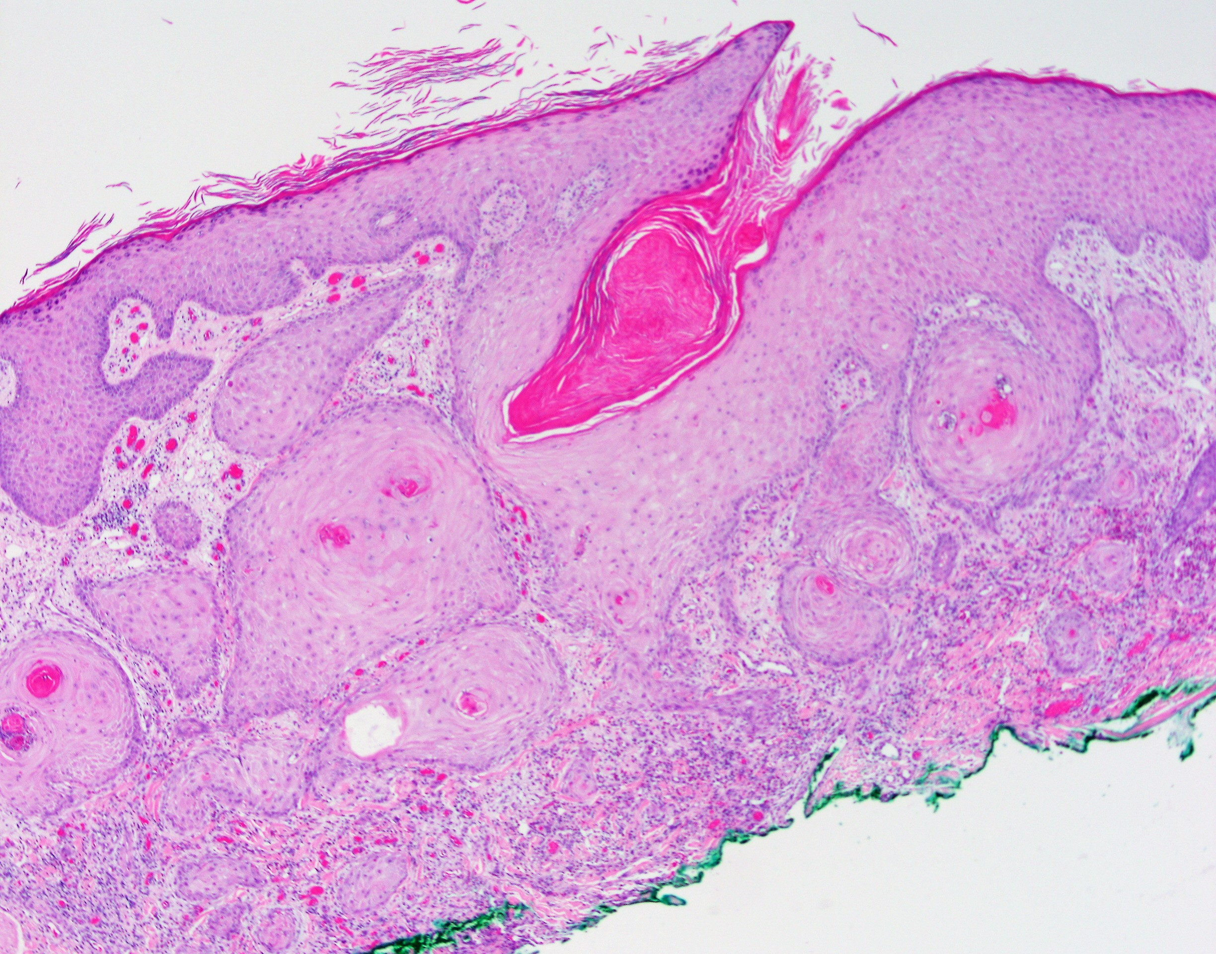 Squamous Cell Carcinoma1