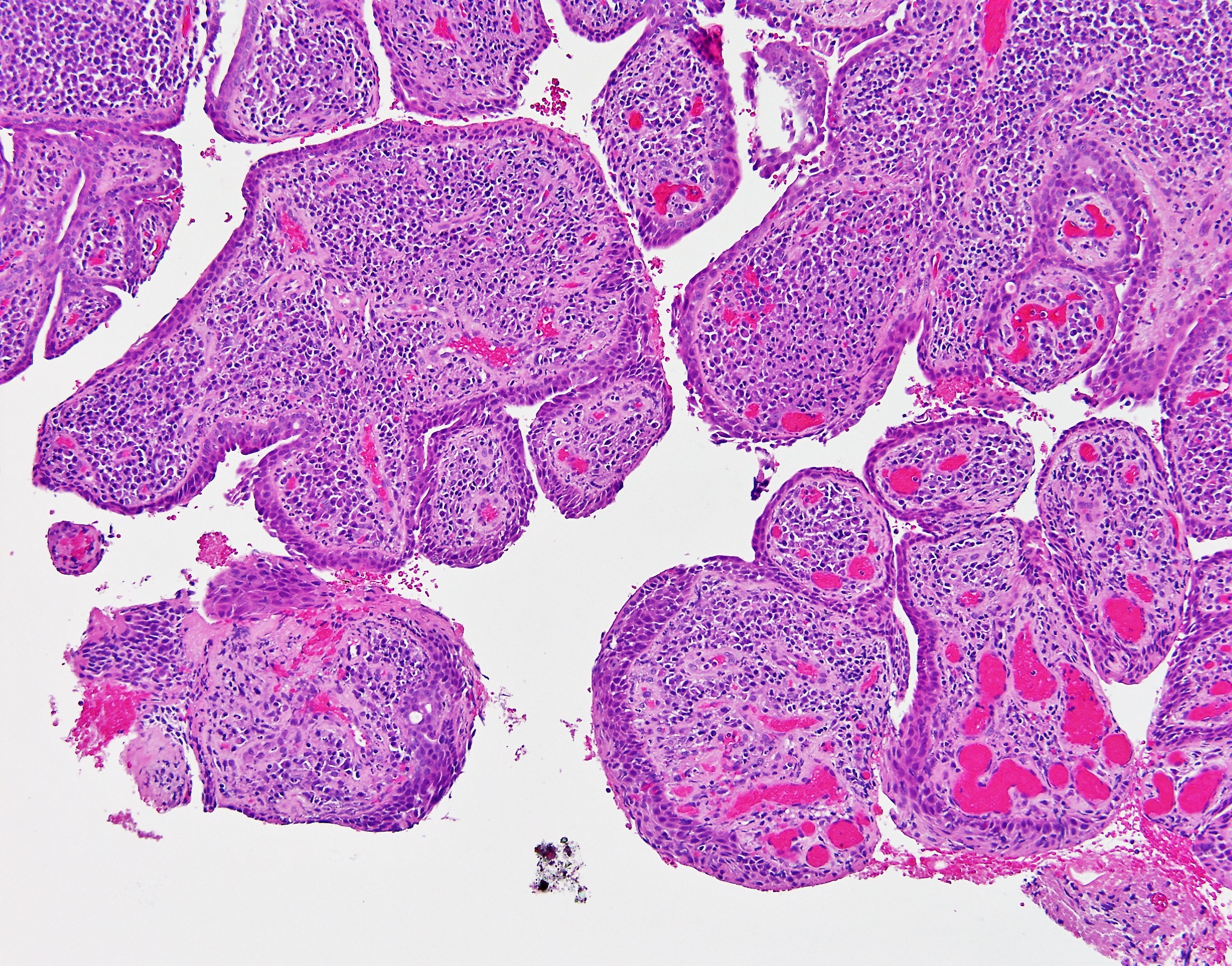 Syringocystadenoma papillerum1