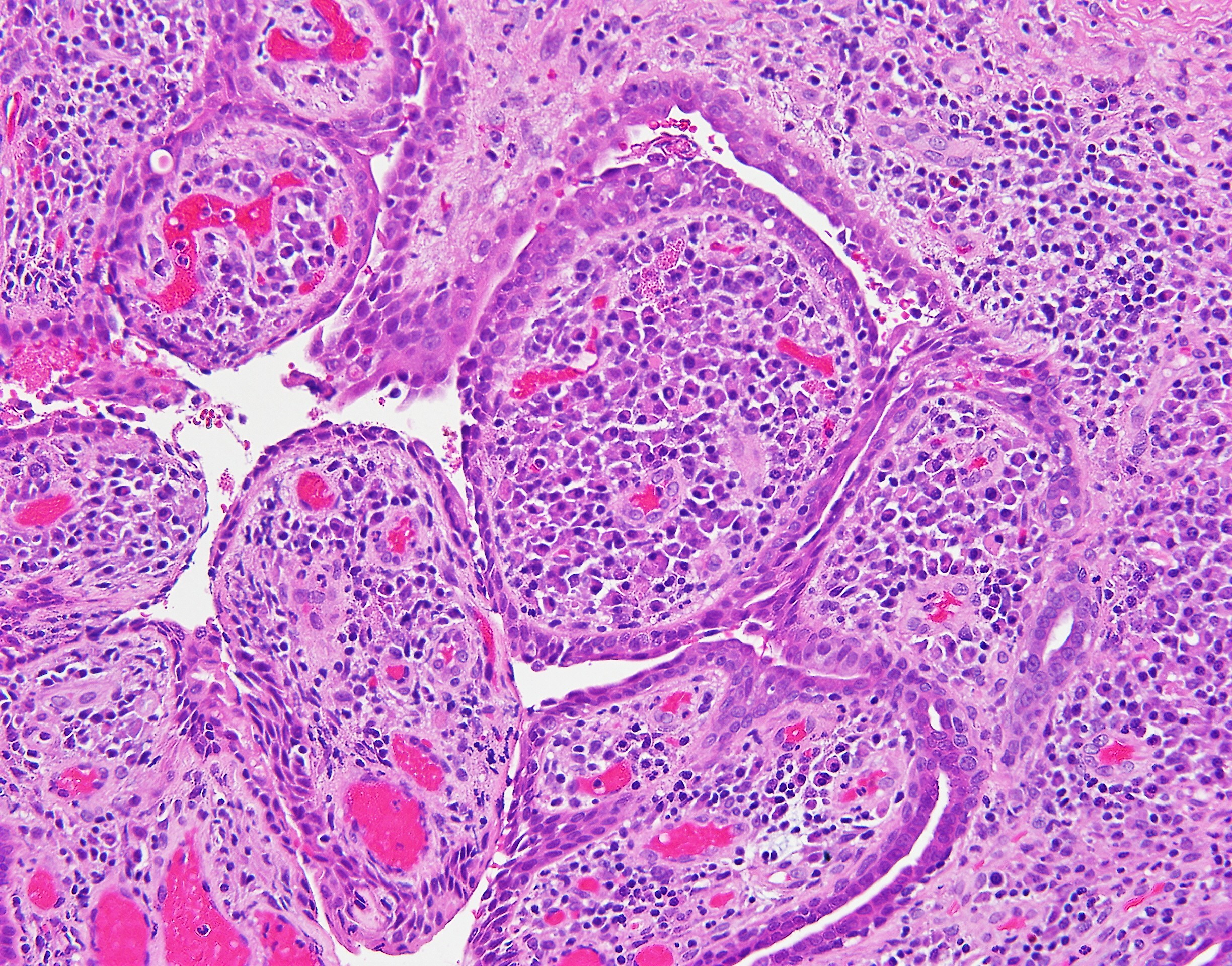 Syringocystadenoma papillerum2